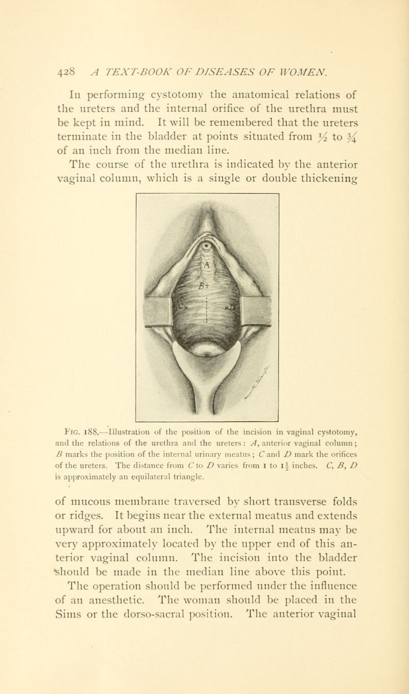 In performing cystotomy the anatomical relations of the ureters and the internal orifice of the urethra must be kept in mind. It will be remembered that the ureters terminate in the bladder at points situated from ^ to ^ of an inch from the median line. The course of the urethra is indicated by the anterior vaginal column, which is a single or double thickening P'lG. 188.—Illustration of the position of the incision in vaginal cystotomy, and the relations of the urethra and the ureters : A, anterior vaginal column; B marks the position of the internal urinary meatus; C and D mark the orifices of the ureters. The distance from C to D varies from I to I* inches. C, B, D is approximately an equilateral triangle. of mucous membrane traversed by short transverse folds or ridges. It begins near the external meatus and extends upward for about an inch. The internal meatus may be very approximately located by the upper end of this an- terior vaginal column. The incision into the bladder should be made in the median line above this point. The operation should be performed under the influence of an anesthetic. The woman should be placed in the Sims or the dorso-sacral position. The anterior vaginal