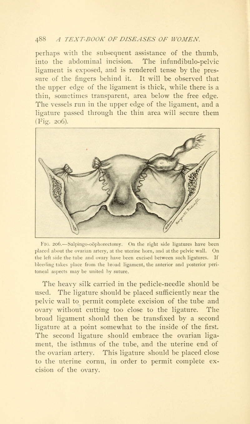 perhaps with the subsequent assistance of the thumb, into the abdominal incision. The infundibulo-pelvic ligament is exposed, and is rendered tense by the pres- sure of the ringers behind it. It will be observed that the upper edge of the ligament is thick, while there is a thin, sometimes transparent, area below the free edge. The vessels run in the upper edge of the ligament, and a ligature passed through the thin area will secure them Fig. 206). Fig. 206.—Salpingo-oophorectomy. On the right side ligatures have been placed about the ovarian artery, at the uterine horn, and at the pelvic wall. On the left side the tube and ovary have been excised between such ligatures. If bleeding takes place from the broad ligament, the anterior and posterior peri- toneal aspects may be united by suture. The heavy silk carried in the pedicle-needle should be used. The ligature should be placed sufficiently near the pelvic wall to permit complete excision of the tube and ovary without cutting too close to the ligature. The broad ligament should then be transfixed by a second ligature at a point somewhat to the inside of the first. The second ligature should embrace the ovarian liga- ment, the isthmus of the tube, and the uterine end of the ovarian artery. This ligature should be placed close to the uterine cornu, in order to permit complete ex- cision of the ovary.