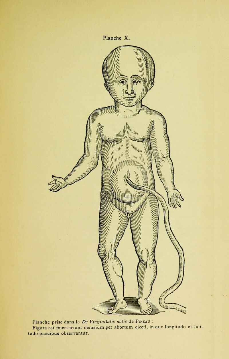 Planche prise dans le De Virginitatis notis de Pineau : Figura est pueri trium mensium per abortum ejecti, in quo longitudo et lati- tudo praecipue observantur.