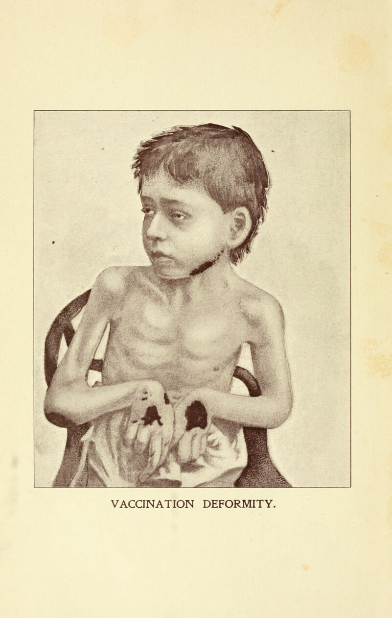 VACCINATION DEFORMITY.