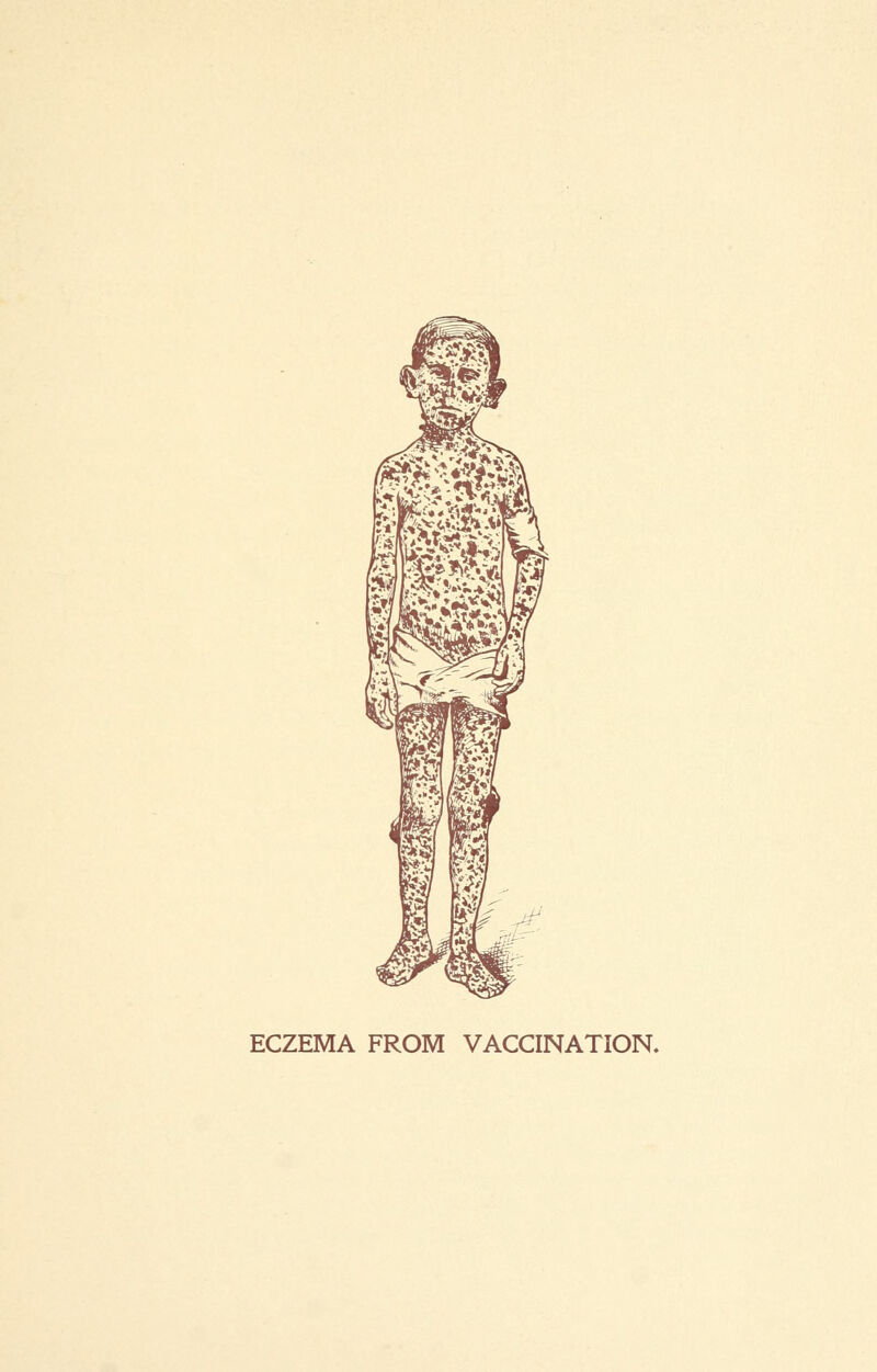 ECZEMA FROM VACCINATION.