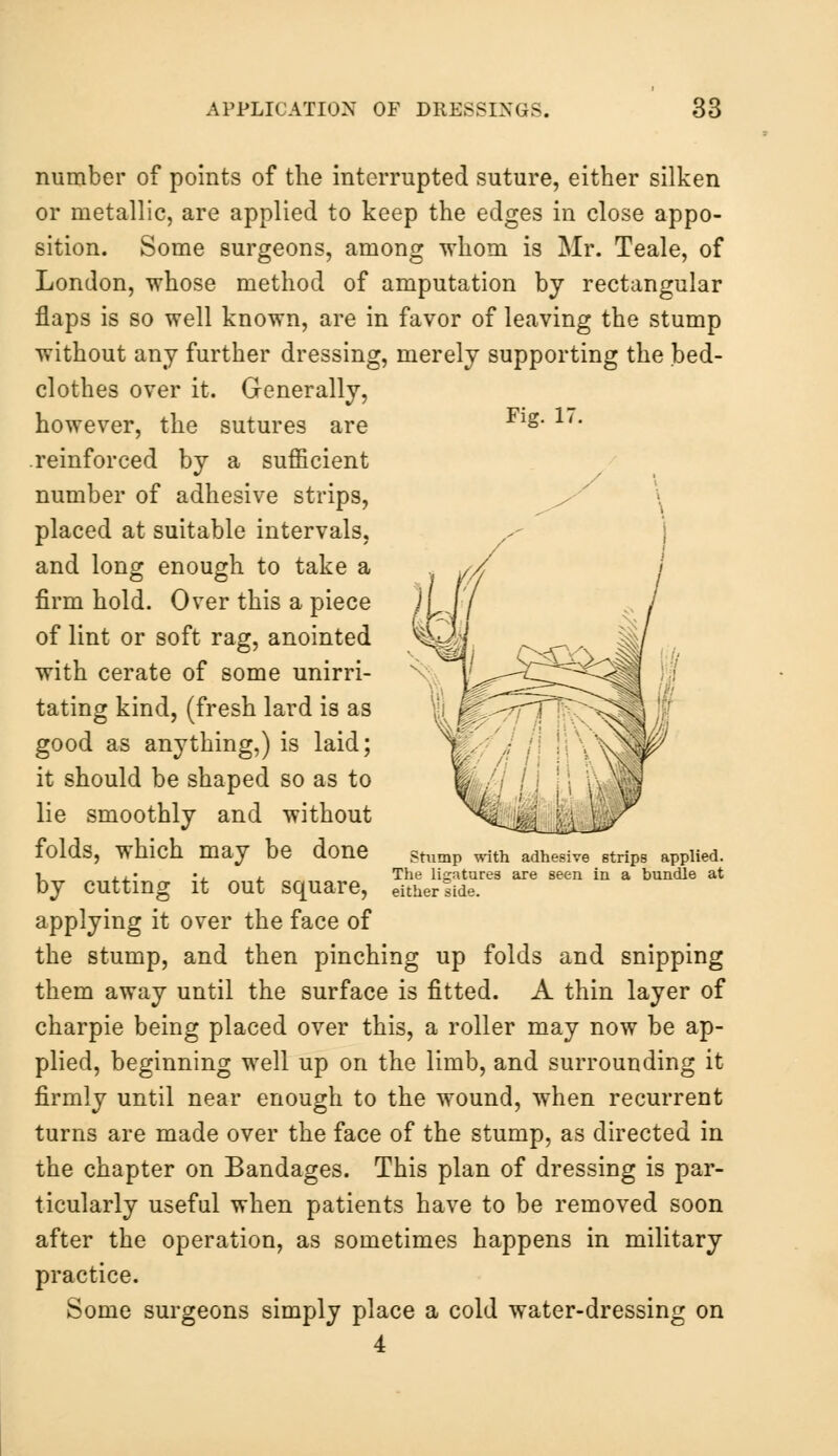 number of points of the interrupted suture, either silken or metallic, are applied to keep the edges in close appo- sition. Some surgeons, among whom is Mr. Teale, of London, whose method of amputation by rectangular flaps is so well known, are in favor of leaving the stump without any further dressing, merely supporting the bed- clothes over it. Generally, however, the sutures are Flg* 17, reinforced by a sufficient number of adhesive strips, placed at suitable intervals, and long enough to take a firm hold. Over this a piece of lint or soft rag, anointed with cerate of some unirri- tating kind, (fresh lard is as good as anything,) is laid; it should be shaped so as to lie smoothly and without folds, which may be done Stump ^th adhesive strips applied. i . , • • , The ligatures Eire seen in a bundle at by cutting it out square, eitherlide. applying it over the face of the stump, and then pinching up folds and snipping them away until the surface is fitted. A thin layer of charpie being placed over this, a roller may now be ap- plied, beginning well up on the limb, and surrounding it firmly until near enough to the wound, when recurrent turns are made over the face of the stump, as directed in the chapter on Bandages. This plan of dressing is par- ticularly useful when patients have to be removed soon after the operation, as sometimes happens in military practice. Some surgeons simply place a cold water-dressing on