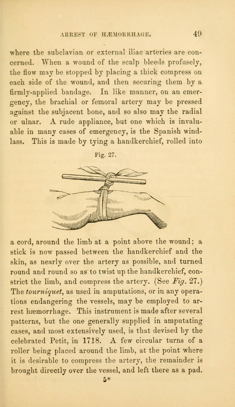 where the subclavian or external iliac arteries are con- cerned. When a wound of the scalp bleeds profusely, the flow may be stopped by placing a thick compress on each side of the wound, and then securing them by a firmly-applied bandage. In like manner, on an emer- gency, the brachial or femoral artery may be pressed against the subjacent bone, and so also may the radial or ulnar. A rude appliance, but one which is invalu- able in many cases of emergency, is the Spanish wind- lass. This is made by tying a handkerchief, rolled into Fiz. 27. a cord, around the limb at a point above the wound; a stick is now passed between the handkerchief and the skin, as nearly over the artery as possible, and turned round and round so as to twist up the handkerchief, con- strict the limb, and compress the artery. (See Fig. 27.) The tourniquet, as used in amputations, or in any opera- tions endangering the vessels, may be employed to ar- rest haemorrhage. This instrument is made after several patterns, but the one generally supplied in amputating cases, and most extensively used, is that devised by the celebrated Petit, in 1718. A few circular turns of a roller being placed around the limb, at the point where it is desirable to compress the artery, the remainder is brought directly over the vessel, and left there as a pad. 5*