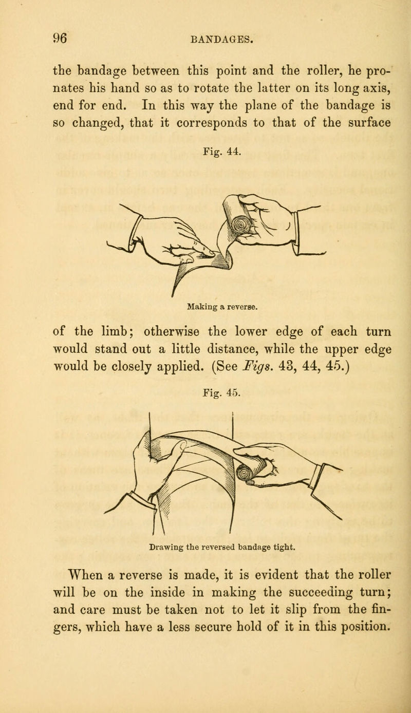 the bandage between this point and the roller, he pro- nates his hand so as to rotate the latter on its long axis, end for end. In this way the plane of the bandage is so changed, that it corresponds to that of the surface Fig. 44. Making a reverse. of the limb; otherwise the lower edge of each turn would stand out a little distance, while the upper edge would be closely applied. (See Figs. 43, 44, 45.) Fig. 45. Drawing the reversed bandage tight. When a reverse is made, it is evident that the roller will be on the inside in making the succeeding turn; and care must be taken not to let it slip from the fin- gers, which have a less secure hold of it in this position.