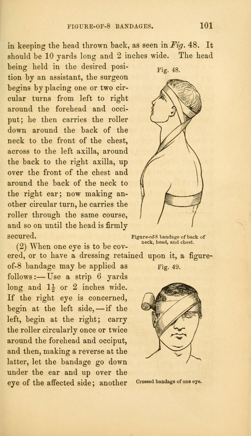 in keeping the head thrown back, as seen mFig. 48. It should be 10 yards long and 2 inches wide. The head being held in the desired posi- -p. 4g tion by an assistant, the surgeon begins by placing one or two cir- cular turns from left to right around the forehead and occi- put; he then carries the roller down around the back of the neck to the front of the chest, across to the left axilla, around the back to the right axilla, up over the front of the chest and around the back of the neck to the right ear; now making an- other circular turn, he carries the roller through the same course, and so on until the head is firmly secured. (2) When one eye is to be cov- ered, or to have a dressing retained upon it, a figure- of-8 bandage may be applied as Fig. 49. follows :— Use a strip 6 yards long and 1J or 2 inches wide. If the right eye is concerned, begin at the left side, — if the left, begin at the right; carry the roller circularly once or twice around the forehead and occiput, and then, making a reverse at the latter, let the bandage go down under the ear and up over the eye Of the affected side; another Crossed bandage of one eye. Figure-of-8 bandage of back of neck, head, and chest.