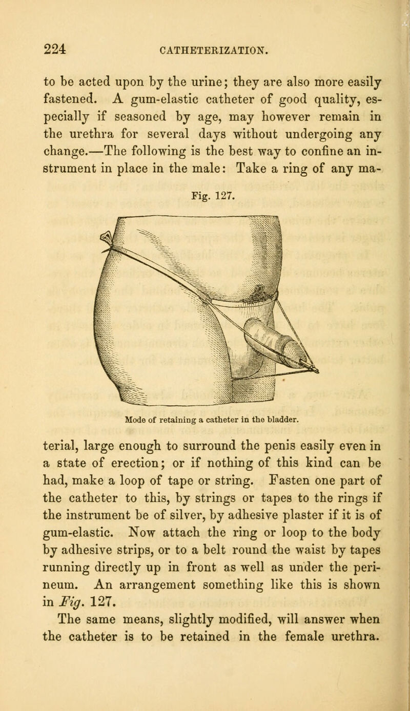 to be acted upon by the urine; they are also more easily fastened. A gum-elastic catheter of good quality, es- pecially if seasoned by age, may however remain in the urethra for several days without undergoing any change.—The following is the best way to confine an in- strument in place in the male: Take a ring of any ma- Fig. 127. Mode of retaining a catheter in the hladder. terial, large enough to surround the penis easily even in a state of erection; or if nothing of this kind can be had, make a loop of tape or string. Fasten one part of the catheter to this, by strings or tapes to the rings if the instrument be of silver, by adhesive plaster if it is of gum-elastic. Now attach the ring or loop to the body by adhesive strips, or to a belt round the waist by tapes running directly up in front as well as under the peri- neum. An arrangement something like this is shown in Fig. 127. The same means, slightly modified, will answer when the catheter is to be retained in the female urethra.