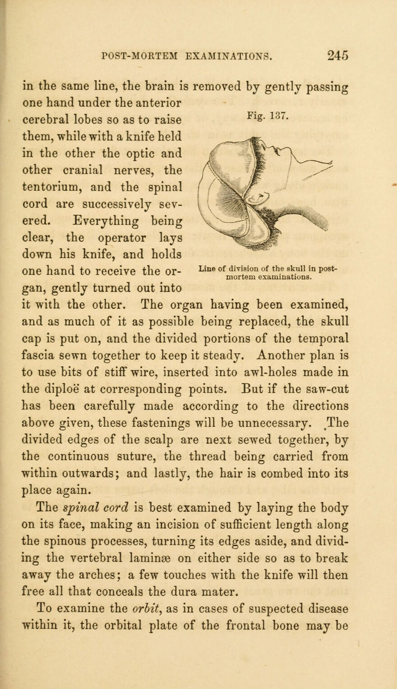 Line of division of the skull in post- mortem examinations. in the same line, the brain is removed by gently passing one hand under the anterior cerebral lobes so as to raise Flg> 137# them, while with a knife held in the other the optic and other cranial nerves, the tentorium, and the spinal cord are successively sev- ered. Everything being clear, the operator lays down his knife, and holds one hand to receive the or- gan, gently turned out into it with the other. The organ having been examined, and as much of it as possible being replaced, the skull cap is put on, and the divided portions of the temporal fascia sewn together to keep it steady. Another plan is to use bits of stiff wire, inserted into awl-holes made in the diploe at corresponding points. But if the saw-cut has been carefully made according to the directions above given, these fastenings will be unnecessary. .The divided edges of the scalp are next sewed together, by the continuous suture, the thread being carried from within outwards; and lastly, the hair is combed into its place again. The spinal cord is best examined by laying the body on its face, making an incision of sufficient length along the spinous processes, turning its edges aside, and divid- ing the vertebral laminae on either side so as to break away the arches; a few touches with the knife will then free all that conceals the dura mater. To examine the orbit, as in cases of suspected disease within it, the orbital plate of the frontal bone may be