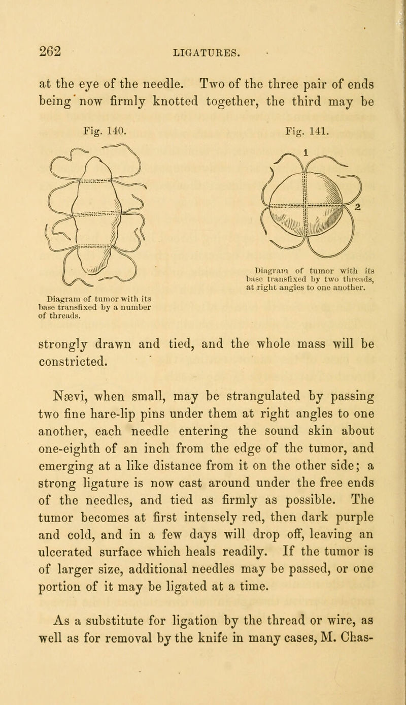 at the eye of the needle. Two of the three pair of ends being'now firmly knotted together, the third may be Fig. 140. Diagram of tumor with its base transfixed by two th reads, at right angles to one another. Diagram of tumor with its base transfixed by a number of threads. strongly drawn and tied, and the whole mass will be constricted. Nsevi, when small, may be strangulated by passing two fine hare-lip pins under them at right angles to one another, each needle entering the sound skin about one-eighth of an inch from the edge of the tumor, and emerging at a like distance from it on the other side; a strong ligature is now cast around under the free ends of the needles, and tied as firmly as possible. The tumor becomes at first intensely red, then dark purple and cold, and in a few days will drop off, leaving an ulcerated surface which heals readily. If the tumor is of larger size, additional needles may be passed, or one portion of it may be ligated at a time. As a substitute for ligation by the thread or wire, as well as for removal by the knife in many cases, M. Chas-