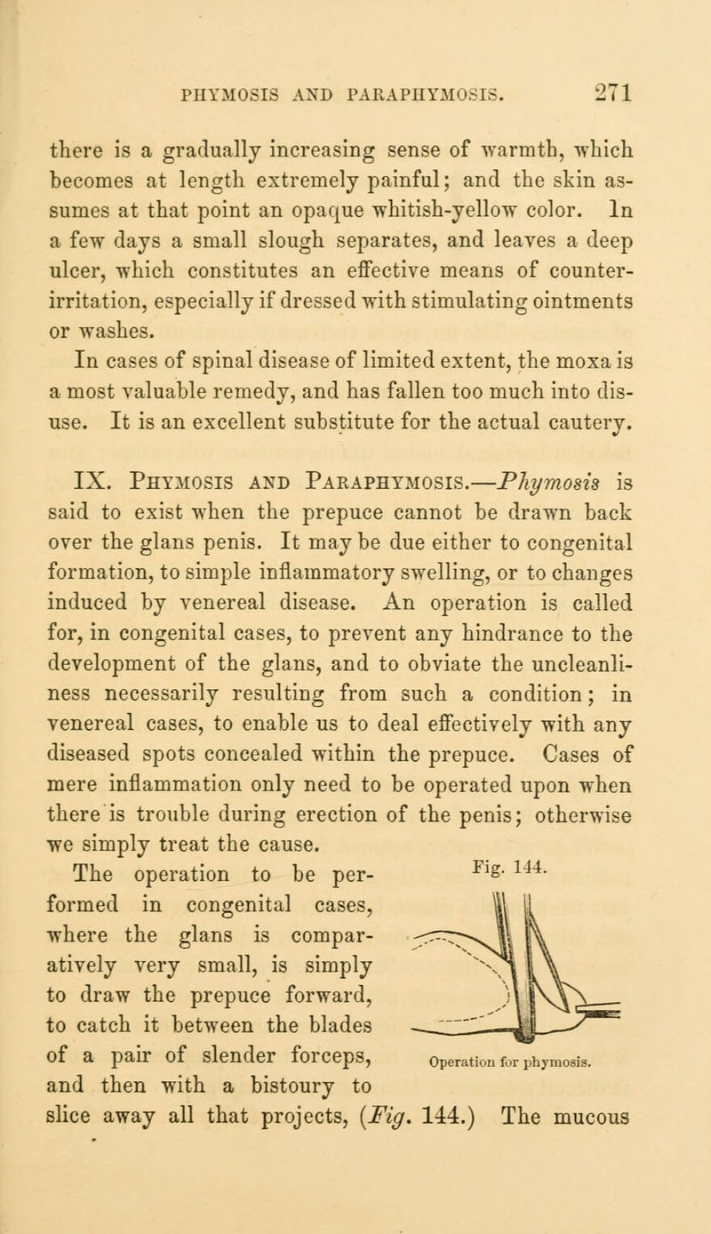 there is a gradually increasing sense of warmth, which becomes at length extremely painful; and the skin as- sumes at that point an opaque whitish-yellow color. In a few days a small slough separates, and leaves a deep ulcer, which constitutes an effective means of counter- irritation, especially if dressed with stimulating ointments or washes. In cases of spinal disease of limited extent, the moxa is a most valuable remedy, and has fallen too much into dis- use. It is an excellent substitute for the actual cautery. IX. Phimosis and Paraphymosis.—Phymosis is said to exist when the prepuce cannot be drawn back over the glans penis. It may be due either to congenital formation, to simple inflammatory swelling, or to changes induced by venereal disease. An operation is called for, in congenital cases, to prevent any hindrance to the development of the glans, and to obviate the uncleanli- ness necessarily resulting from such a condition; in venereal cases, to enable us to deal effectively with any diseased spots concealed within the prepuce. Cases of mere inflammation only need to be operated upon when there is trouble during erection of the penis; otherwise we simply treat the cause. The operation to be per- Fls- 1U- formed in congenital cases, where the glans is compar- atively very small, is simply to draw the prepuce forward, to catch it between the blades of a pair of slender forceps, operation for phymosis. and then with a bistoury to slice away all that projects, {Fig. 144.) The mucous