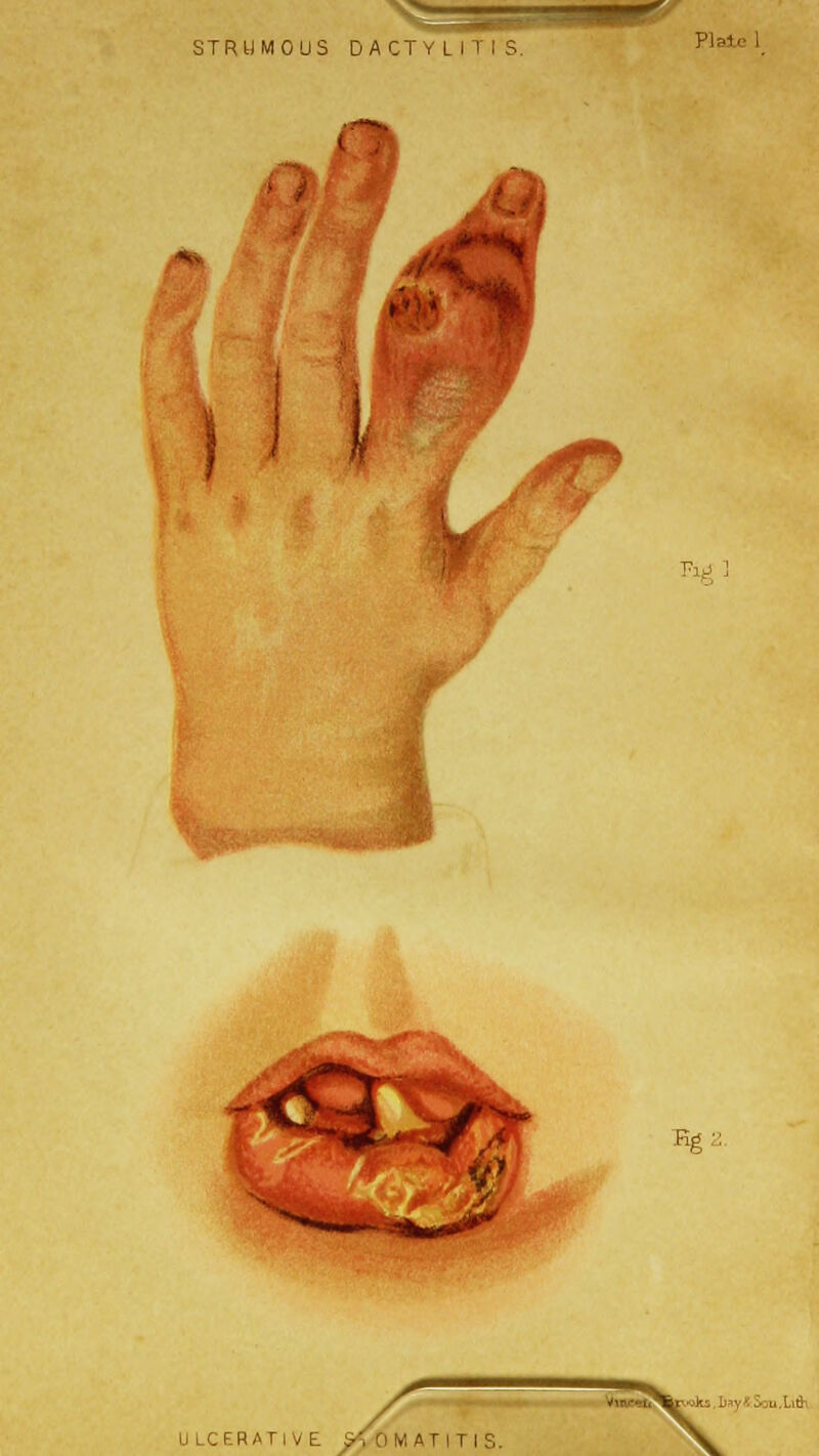 STRUMOUS DACTY L ITI S. Plate } I Fit! ■ ,. v. ULCERATIVE SA (\ M A T I T I S. X
