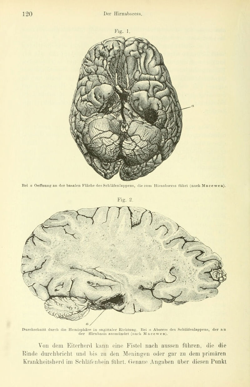 Bei a Oeffnung an der basalen Fläche des Schläfenlappens, die zum Himabscess fübrt (nach Mace wen). Piff. 2. Durchschnitt durch die Hemisphäre in sagittaler Richtung. Dei a Abscess des Schläfenlappens, der an der Hirnbasis ausmündet (nach Macewen). Von dem Eiterherd kann eine Fistel nach aussen führen, die die Rinde durchbricht und bis zu den Meningen oder gar zu dem primären Krankheitsherd im Schläfenbein führt. Genaue Angaben über diesen Punkt