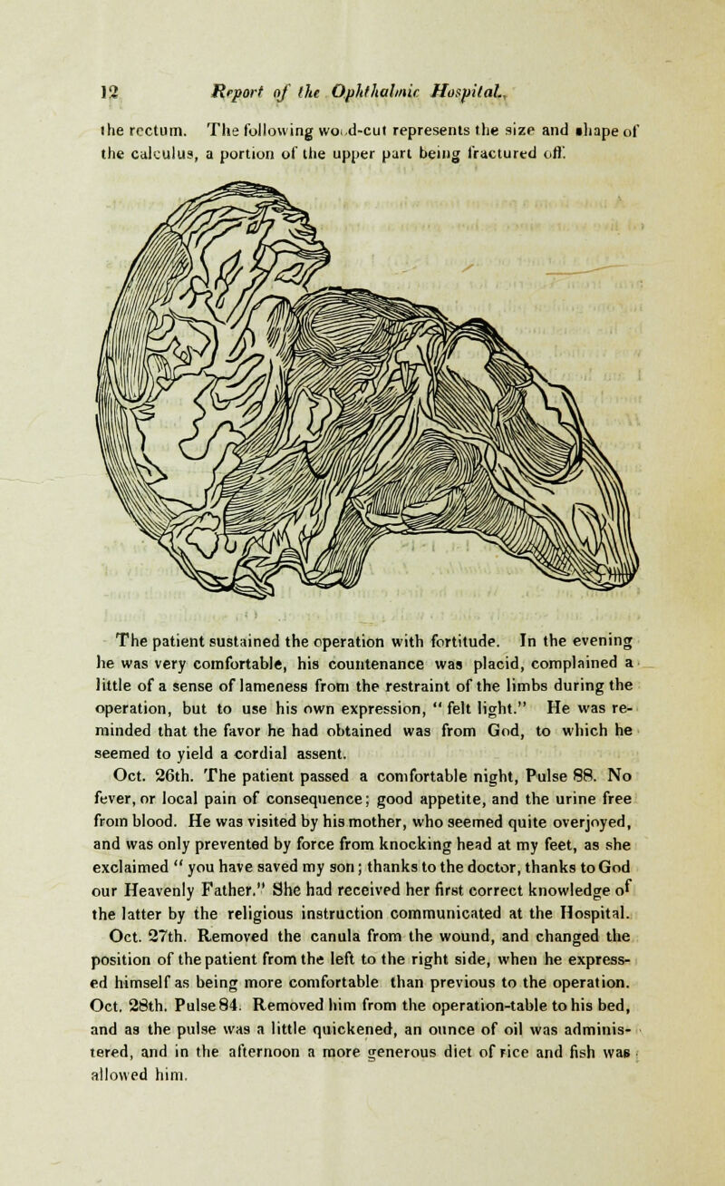 the rectum. The following woi.d-cut represents the size and shape of the calculus, a portion of the upper part being fractured ofl'. The patient sustained the operation with fortitude. In the evening he was very comfortable, his countenance was placid, complained a little of a sense of lameness from the restraint of the limbs during the operation, but to use his own expression, felt light. He was re- minded that the favor he had obtained was from God, to which he seemed to yield a cordial assent. Oct. 26th. The patient passed a comfortable night, Pulse 88. No fever, or local pain of consequence; good appetite, and the urine free from blood. He was visited by his mother, who seemed quite overjoyed, and was only prevented by force from knocking head at my feet, as she exclaimed you have saved my son; thanks to the doctor, thanks to God our Heavenly Father. She had received her first correct knowledge of the latter by the religious instruction communicated at the Hospital. Oct. 27th. Removed the canula from the wound, and changed the position of the patient from the left to the right side, when he express- ed himself as being more comfortable than previous to the operation. Oct. 28th. Pulse 84. Removed him from the operation-table to his bed, and as the pulse was a little quickened, an ounce of oil was adminis- tered, and in the afternoon a more generous diet of rice and fish was allowed him.
