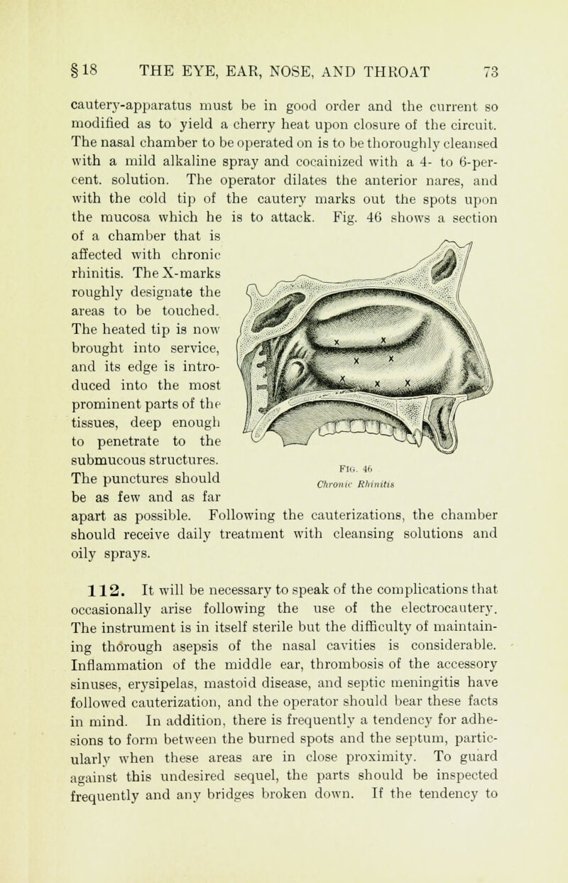 cautery-apparatus must be in good order and the current so modified as to yield a cherry heat upon closure of the circuit. The nasal chamber to be operated on is to be thoroughly cleansed with a mild alkaline spray and cocainized with a 4- to 6-per- cent, solution. The operator dilates the anterior nares, and with the cold tip of the cautery marks out the spots upon the mucosa which he is to attack. Fig. 46 shows a section of a chamber that is affected with chronic rhinitis. TheX-marks roughly designate the areas to be touched. The heated tip is now brought into service, and its edge is intro- duced into the most prominent parts of the tissues, deep enough to penetrate to the submucous structures. The punctures should be as few and as far apart as possible. Following the cauterizations, the chamber should receive daily treatment with cleansing solutions and oily sprays. i^xrt^ Fit;. 46 Chronic Rhinitis 112. It will be necessary to speak of the complications that occasionally arise following the use of the electrocautery. The instrument is in itself sterile but the difficulty of maintain- ing thorough asepsis of the nasal cavities is considerable. Inflammation of the middle ear, thrombosis of the accessory sinuses, erysipelas, mastoid disease, and septic meningitis have followed cauterization, and the operator should bear these facts in mind. In addition, there is frequently a tendency for adhe- sions to form between the burned spots and the septum, partic- ularly when these areas are in close proximity. To guard against this undesired sequel, the parts should be inspected frequently and any bridges broken down. If the tendency to