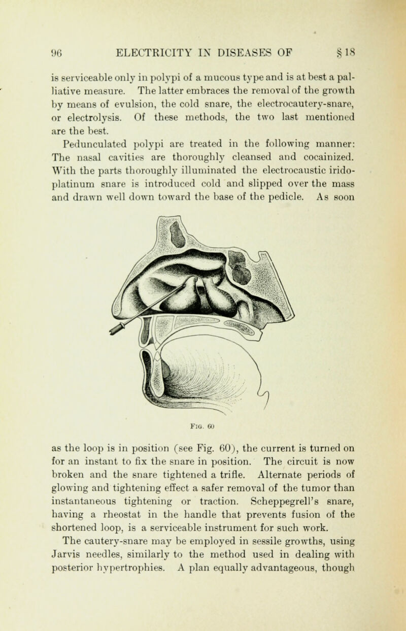 is serviceable only in polypi of a mucous type and is at best a pal- liative measure. The latter embraces the removal of the growth by means of evulsion, the cold snare, the electrocautery-snare, or electrolysis. Of these methods, the two last mentioned are the best. Pedunculated polypi are treated in the following manner: The nasal cavities are thoroughly cleansed and cocainized. With the parts thoroughly illuminated the electrocaustic irido- platinum snare is introduced cold and slipped over the mass and drawn well down toward the base of the pedicle. As soon Fig. 60 as the loop is in position (see Fig. 60), the current is turned on for an instant to fix the snare in position. The circuit is now broken and the snare tightened a trifle. Alternate periods of glowing and tightening effect a safer removal of the tumor than instantaneous tightening or traction. Scheppegrell's snare, having a rheostat in the handle that prevents fusion of the shortened loop, is a serviceable instrument for such work. The cautery-snare may be employed in sessile growths, using Jarvis needles, similarly to the method used in dealing with posterior hypertrophies. A plan equally advantageous, though