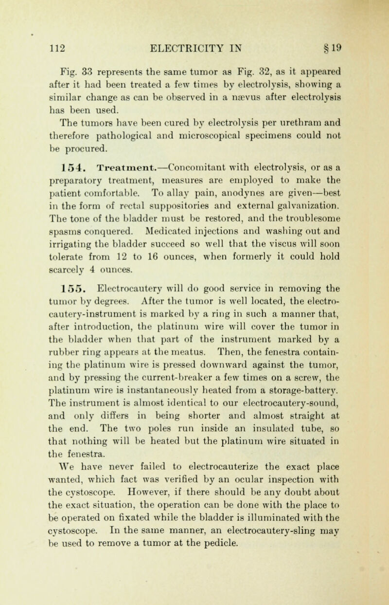 Fig. 33 represents the same tumor as Fig. 32, as it appeared after it had been treated a few times by electrolysis, showing a similar change as can be observed in a nsevus after electrolysis has been used. The tumors have been cured by electrolysis per urethram and therefore pathological and microscopical specimens could not be procured. 1 54. Treatment.—Concomitant with electrolysis, or as a preparatory treatment, measures are employed to make the patient comfortable. To allay pain, anodynes are given—best in the form of rectal suppositories and external galvanization. The tone of the bladder must be restored, and the troublesome spasms conquered. Medicated injections and washing out and irrigating the bladder succeed so well that the viscus will soon tolerate from 12 to 16 ounces, when formerly it could hold scarcely 4 ounces. L55. Electrocautery will do good service in removing the tumor by degrees. After the tumor is well located, the electro- cautery-instrument is marked by a ring in such a manner that, after introduction, the platinum wire will cover the tumor in the bladder when that part of the instrument marked by a rubber ring appears at the meatus. Then, the fenestra contain- ing the platinum wire is pressed downward against the tumor, and by pressing the current-breaker a few times on a screw, the platinum wire is instantaneously heated from a storage-battery. The instrument is almost identical to our electrocautery-sound, and only differs in being shorter and almost straight at the end. The two poles run inside an insulated tube, so that nothing will be heated but the platinum wire situated in the fenestra. We have never failed to electrocauterize the exact place wanted, which fact was verified by an ocular inspection with the cystoscope. However, if there should be any doubt about the exact situation, the operation can be done with the place to be operated on fixated while the bladder is illuminated with the cystoscope. In the same manner, an electrocautery-sling may be used to remove a tumor at the pedicle.