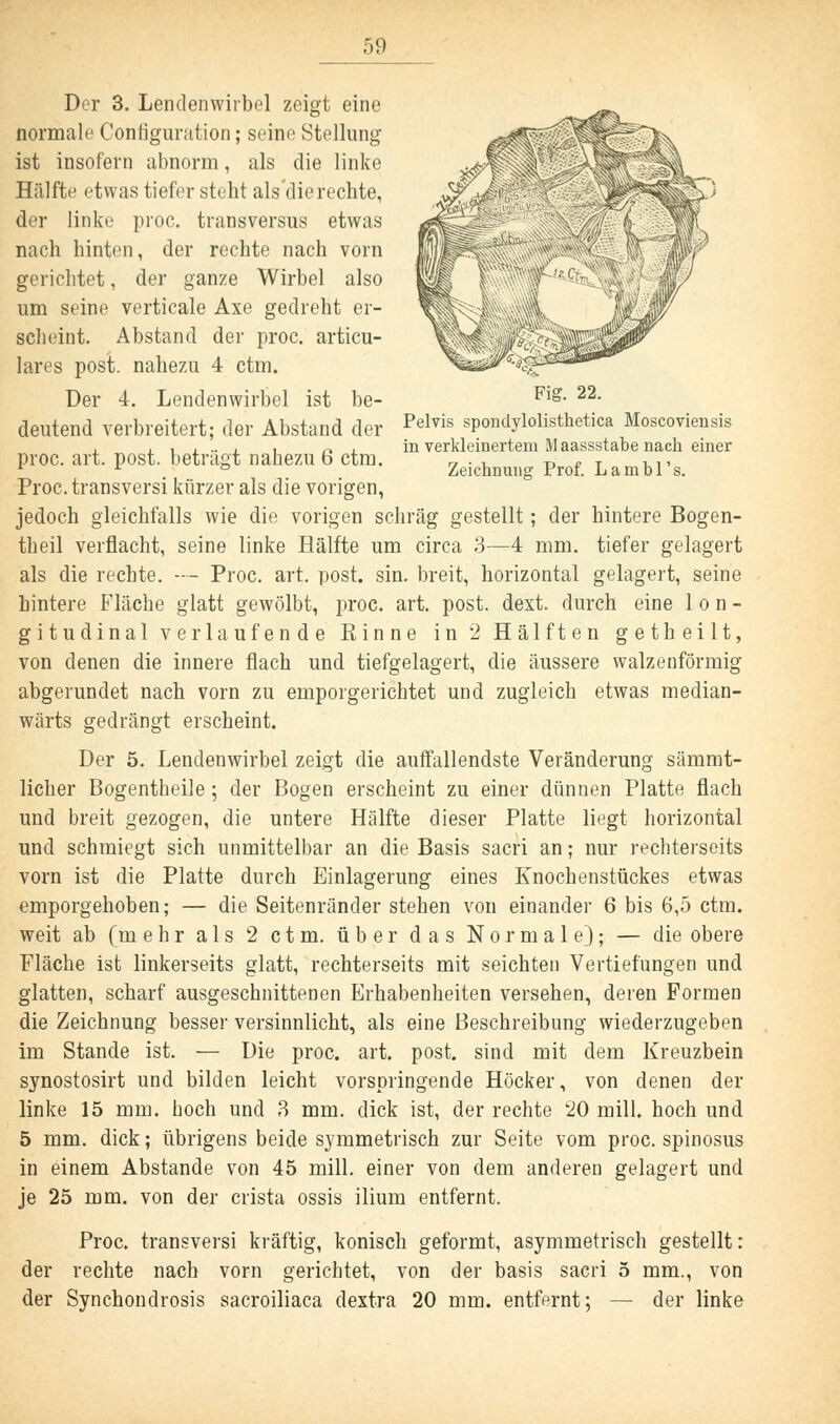 Fig. 22. Pelvis spondylolisthetica Moscoviensis in verkleinertem 11 aassstabe nach einer Zeichnung Prof. Lambl's. Der 3. Lendenwirbel zeigt eine normale Contiguration; seine Stellung ist insofern abnorm, als die linke Hälfte etwas tiefer steht als'die rechte, der linke proc. transversus etwas nach hinten, der rechte nach vorn gerichtet, der ganze Wirbel also um seine verticale Axe gedreht er- scheint. Abstand der proc. articu- lares post. nahezu 4 ctm. Der 4. Lendenwirbel ist be- deutend verbreitert; der Abstand der proc. art. post. beträgt nahezu 6 ctm. Proc. transversi kürzer als die vorigen, jedoch gleichfalls wie die vorigen schräg gestellt; der hintere Bogen- theil verflacht, seine linke Hälfte um circa 3—4 mm. tiefer gelagert als die rechte. -- Proc. art. post. sin. breit, horizontal gelagert, seine hintere Fläche glatt gewölbt, proc. art. post. dext. durch eine lon- gitudinal verlaufende Rinne in 2 Hälften getheilt, von denen die innere flach und tiefgelagert, die äussere walzenförmig abgerundet nach vorn zu emporgerichtet und zugleich etwas median- wärts gedrängt erscheint. Der 5. Lendenwirbel zeigt die auffallendste Veränderung sämmt- licher Bogentheile ; der Bogen erscheint zu einer dünnen Platte flach und breit gezogen, die untere Hälfte dieser Platte liegt horizontal und schmiegt sich unmittelbar an die Basis sacri an; nur rechterseits vorn ist die Platte durch Einlagerung eines Knochenstückes etwas emporgehoben; — die Seitenränder stehen von einander 6 bis 6,5 ctm. weit ab (mehr als 2 ctm. über das Normale); — die obere Fläche ist linkerseits glatt, rechterseits mit seichten Vertiefungen und glatten, scharf ausgeschnittenen Erhabenheiten versehen, deren Formen die Zeichnung besser versinnlicht, als eine Beschreibung wiederzugeben im Stande ist. — Die proc. art. post. sind mit dem Kreuzbein synostosirt und bilden leicht vorspringende Höcker, von denen der linke 15 mm. hoch und 3 mm. dick ist, der rechte 20 mill. hoch und 5 mm. dick; übrigens beide symmetrisch zur Seite vom proc. spinosus in einem Abstände von 45 mill. einer von dem anderen gelagert und je 25 mm. von der crista ossis ilium entfernt. Proc. transversi kräftig, konisch geformt, asymmetrisch gestellt: der rechte nach vorn gerichtet, von der basis sacri 5 mm., von der Synchondrosis sacroiliaca dextra 20 mm. entfernt; — der linke