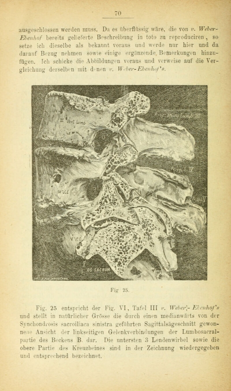 ausgeschlossen werden nrass. D 3 Ol Büssig -. i xon v. Weber- /; bereits gelieferte B Schreibung in toto zu reproduciren, setze ich dieselbe als bekannt voraus und werde nur hier und da darauf B-zug nahmen sowie einige ergänzende B-rm-rkungen hinzc- . Ich schicke die Abbildungen voraus und verweise auf die Ver- iiung derselben mit d-n-n v. W 'er-E : _ .■ . 25 entspricht der Fig. VI, Tafel III v. Weber\-El nhofs und stellt in natürlicher Grösse die durch ein^n medianwärts von der Synchondrosis sacroiliac - : stra gerührten Sagittalsägeschnitt gewon- ne Ansicht der linkseitigen Gelenkverbindungen der Lumbosacral- - Beckens B. dar. Die untersten 3 Lendenwirbel sowie die obere Partie des Kreuzbeines sind in der Zeichnung wiedergegeben und tsj hend bezeichne!