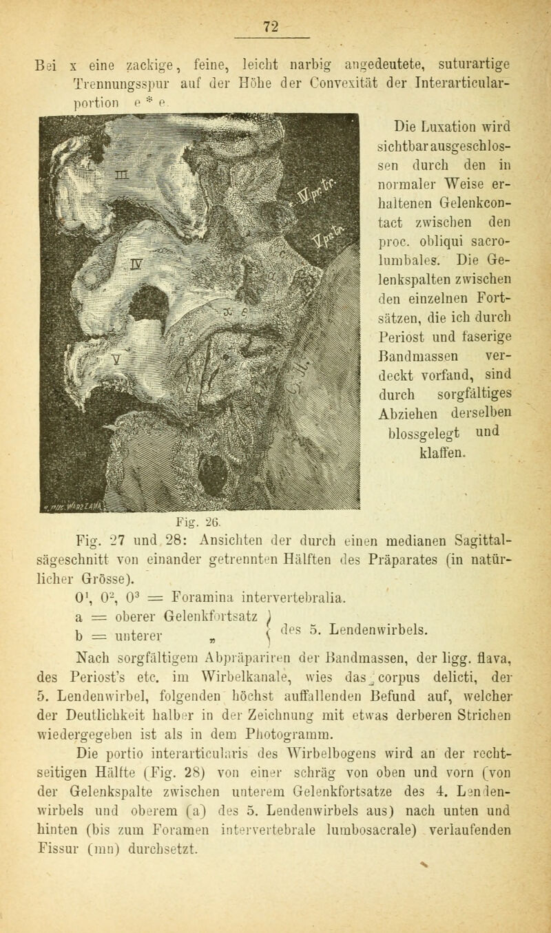 Bei x eine zackige, feine, leicht narbig angedeutete, suturartige Trennungsspur auf der Höbe der Convexität der Interarticular- portion e * e Die Luxation wird siebtbar ausgeschlos- sen durch den in normaler Weise er- haltenen Gelenkcon- tact zwischen den proc. obliqui sacro- lumbales. Die Ge- len kspalten zwischen den einzelnen Fort- sätzen, die ich durch Periost und faserige Bandniassen ver- deckt vorfand, sind durch sorgfältiges Abziehen derselben blossgelegt und klaffen. Fig. -26. Fig. '11 und 28: Ansichten der durch einen medianen Sagittal- sägeschnitt von einander getrennten Hälften des Präparates (in natür- licher Grösse). O1, 02, O3 = Foramina intervertebralia. a = oberer Gelenkf »rtsatz des 5. Lendenwirbels. b = unterer „ Nach sorgfältigem Abpräparireq der Bandmassen, der ligg. flava, des Periost's etc. im Wirbelkanale, wies das _, corpus delicti, der 5. Lendenwirbel, folgenden höchst auffallenden Befund auf, welcher der Deutlichkeit halber in der Zeichnung mit etwas derberen Strichen wiedergegeben ist als in dem Pliotogramm. Die portio interarticularis des Wirbelbogens wird an der recht- seitigen Hälfte (Fig. 28) von einer schräg von oben und vorn (von der Gelenkspalte zwischen unterem Gelenkfortsatze des 4. Lenden- wirbels und oberem (a) des 5. Lendenwirbels aus) nach unten und hinten (bis zum Foramen intervertebrale lumbosacrale) verlaufenden Fissur (ran) durchsetzt.