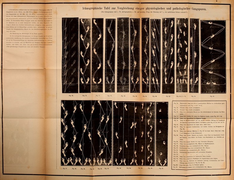 ') Die Reduclion entbehrt leider der mathematischen Genauigkeit, indem die angetrecke vou 3, 3 Meter, also 2300 Millim. Linge in den Zeichnungen durch ne Gangstrecke von 152 statt 1S3, 333 Millim repraesenlirt wird, [e-doclt jnrien wir diese mikrometriscbe Ungenanigkeil um so mehr nnbooelilcl ins 'ii, als ja keinerlei innlhuniitisch gesicherte Schlüsse, darauf belogen werden llleii. In forensischen Füllen hingegen muss eine minutiöse Genauigkeit in rr Rcdnclion ihm «u mehr beansprucht «erden, alt unter Umständen dli uiigc u. Breite de» einzelnen Suhlcnubdmcl.e» wenigstem ein« von Schluss auf die Kürperl&Hge gestalten kunn, andererseits die genaue :'■'! d. i i.-(m.>t:ri).|ii ■■ l,< n S1.i..-i- Inr den lik-ltülicilllllg» V I lii.' Kil.lmm.g der AMnl.luiipeii ist im Texte gegeben. 1 ■ Ovulen li'liu»»rn n.'ii i i \vL'iji^'..'i Süi'gfull aul dir yenain crisehe Ausführung der einzelnen FussobdrUcke liiimclillich Muri im in f die Vemnaclmilln Lliny ilci rülilulii'ln ii Anl'-iiiuiiilcilnl^c und Sl.i;llmiM Jer und zur Mittellinie der Qangspiir (Spiirai«) serwandt cn »«eh dnher liier und da kleine Formvenelned' hIk-Hcii r Fussabdrucke einer und derselben Gftngipur ■ dhe Ichnographische Tafel zur Vergleichung einiger physiologischer und pathologischer Gangspuren. (Die Ichnogramuie sind z. Th. photographiscb, ?.. Th. auf directem Wege der Messung auf '/,, der natürlichen Grösse rfiducirt*). L3 Fig. 79. Fig. 80. Fig. 81. Fig. Fig. 83. Fig. 84 (I ii II). Fig Fig. 75. Watschelnd''!- Gang mit K<l<„i>\ i|iindnipednh'iii Habitus bei LurdoscoliosU spon- dylolistheHci (siehe Fig. 1-4 S. 18 U.). Fig. 7G. Normaler (lang (leicht scliematisirt). Fig. 77. Normaler Gang (leicht scliematisirt) Fig, 78. Gang eines erwachsenen Mannes aus dem Arbciter»tands Iwi Ücoliosis des Rtlck- Fig. 79. Gang einer Grafida (VI. meos.) bei Ktphosia doiulii (»eh« Fig. 12 8. 34). Fig. SU, Gang ein.'» Erwachsen«!! hui Kiphosi* dortalis. Fig. 81 Uang bei Bmidfloliatheala mit sog gerader aufrecht« Haltung d*s Oberktirpsr* bei änsserlich krpootUehem Habitus des Beskeiis (ittha Fig. Ii und 19 S. 30 ü). Fig. 8'-'. Uang einer Erwachsenen bei Lusat. femor. dsrtri iliaoa Fig. 83. Gang bei mw'malcr Lendenlordose und leichter Seolios« des Rückgrates («fr. Pig. 96). Fig. 84. Gang eines 4-jihrigen Mädchens (s Fig. 67) bei I.uiat fenior. itiaca dupl. cong I mit Stütioorsart, II ohne Sttttworeett. Fig. 85. üaug einer 3?-j«hr. Tanseriu aus London , derun Vater sin frauiösisclier Creole aua Jamaica deren Mutter di« Tuehter einer Husch msnnin an* Südafrika ge' Gang eines 14-jähr. Knaben bei cong. bilateralem KIunipfiisB. Gang eines norraalgcbauteu 'J6-J Mannes im Begrabniss seh ritt. Langsamer Gang eine» normalgebituten 3C-j. Mannas. Gewöhnlicher Gang «'»es nonnalgebauten 26-j. Mannes. Laufschritt eines normalgebioten 2G-j. Mannes. Gewöhnlicher Marschirscbritt eine- preußischen Grenadiers. Gang eines Erwach neuen hei beginnender Tabes dnrsalis. Gang eines erwachsenen Packtrögers bei doppelseitigem geuu talgnm, Gang eines IS-j. Mädchen» bei maximaler patliulog, Leudeulordos* Imit Unter- sthtiuug doreb Krücken) («. Fig. G2, 66, 66). Uang einer »lau Frau bei Paraljsis agitans. Uallengang (Zugang) eines normalgebauten 26-j. Mannes.