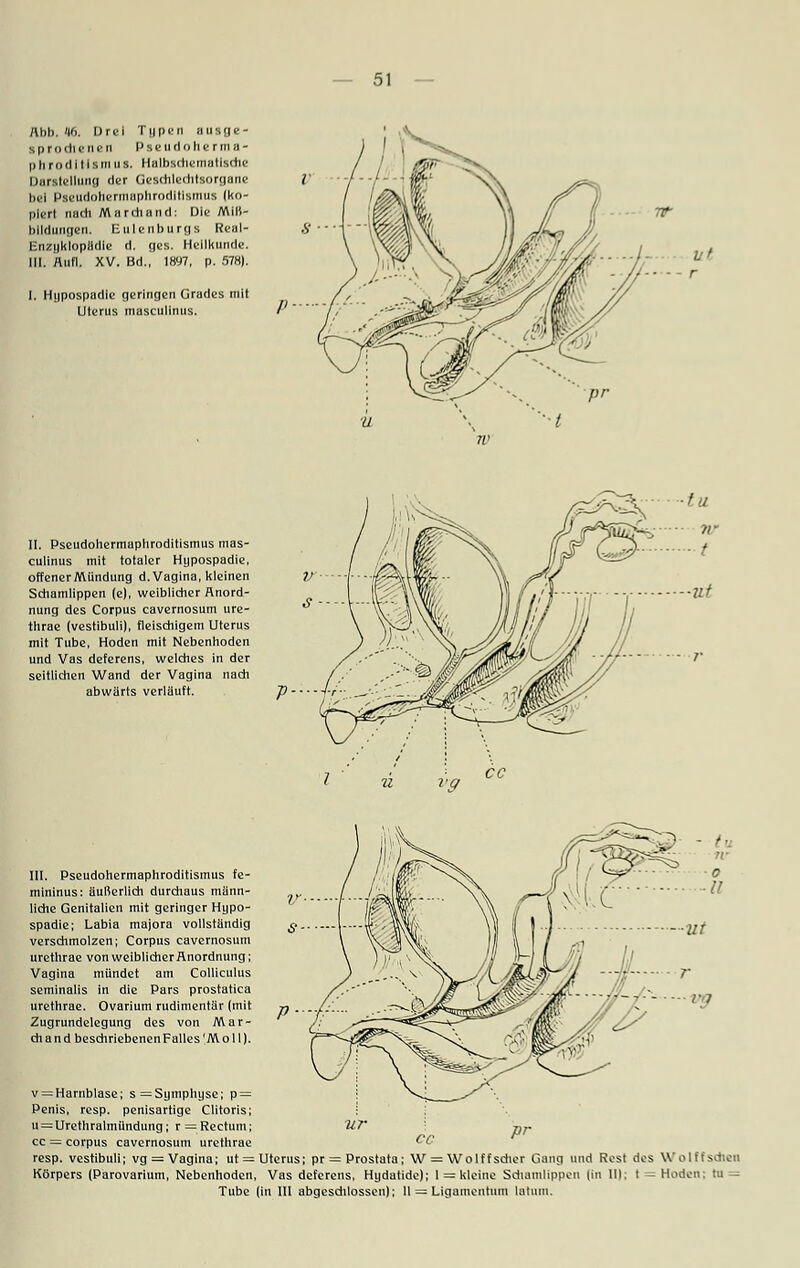 Abb. 46. Drei Typen Busge- S pro eilt III'II PslMUllllllTlllii- phrn(litismus. Halbsdiema tische Darstellung der Geschlechtsorgane bei Pgeudohermaphrodltlsmus (ko- piert nach Mar dl and: Die Miß- bildungen. Eulenburgs Real- Enzuklopädle d. ges. Heilkunde. III. Aufl. XV. Bd., 1897, p. 578). I. Hypospadie geringen Grades mit Uterus masculinus. II. Pseudohermaphroditismus mas- culinus mit totaler Hypospadie, offener Mündung d. Vagina, kleinen Schamlippen (e), weiblicher Anord- nung des Corpus cavernosum ure- thrae (vestibuli), fleischigem Uterus mit Tube, Hoden mit Nebenhoden und Vas deferens, welches in der seitlichen Wand der Vagina nach abwärts verläuft. III. Pseudohermaphroditismus fe- mininus: äußerlich durchaus männ- liche Genitalien mit geringer Hypo- spadie; Labia majora vollständig verschmolzen; Corpus cavernosum urethrae von weiblicher Anordnung; Vagina mündet am Colliculus seminalis in die Pars prostatica urethrae. Ovarium rudimentär (mit Zugrundelegung des von Mar- ch a n d beschriebenen Falles 'Moll). v = Harnblase; s= Symphyse; p= ; Penis, resp. penisartige Clitoris; I u = Urethralmünduiig; r = Rectum; 1iT cc = corpus cavernosum urethrae resp. vestibuli; vg = Vagina; ut = Uterus; pr = Prostata; W = Wolffsdier Gang und Rest des Wolffschen Körpers (Parovarium, Nebenhoden, Vas deferens, Hydatide); 1 = kleine Schamlippen |in 111; t = Hoden: tu— Tube (in III abgeschlossen)! II — Ligamentum latum. cc pr