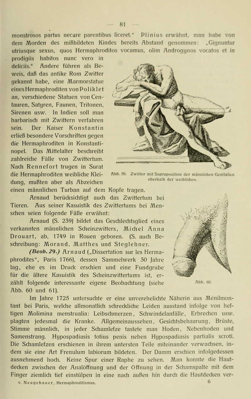 Kl Abb. 59. Zwitter mit Supraposition der männlichen Genitalien oberhalb der weiblichen. monstrosos partus necare parentibus liceret. Plinius erwähnt, man habe von dem Morden des mißbildeten Kindes bereits Abstand genommen: „Gignuntur utriusque sexus, quos Hermaphroditos vocamus, olim Androgynos vocatos et in prodigiis habitos nunc vero in deliciis. Andere führen als Be- weis, daß das antike Rom Zwitter gekannt habe, eine Marmorstatue einesHermaphroditcn von Poliklet an, verschiedene Statuen von Cen- tauren, Satyren, Faunen, Tritonen, Sirenen usw. In Indien soll man barbarisch mit Zwittern verfahren sein. Der Kaiser Konstantin erließ besondere Vorschriften gegen die Hermaphroditen in Konstanti- nopel. Das Mittelalter beschreibt zahlreiche Fälle von Zwittertum. Nach Rennefort trugen in Surat die Hermaphroditen weibliche Klei- dung, mußten aber als Abzeichen einen männlichen Turban auf dem Kopfe tragen. Arnaud berücksichtigt auch das Zwittertum bei Tieren. Aus seiner Kasuistik des Zwittertums bei Men- schen seien folgende Fälle erwähnt: Arnaud (S. 239) bildet das Gcschlechtsglied eines verkannten männlichen Sdieinzwitters, Mi diel Anna Drouart, ab, 1749 in Rotten geboren. (S. audi Be- schreibung: Morand, Matthes und Steglehner. (Beob.29.) Arnaud („Dissertation sur les Herma- phrodites, Paris 1766), dessen Sammelwerk 30 Jahre lag, ehe es im Druck erschien und eine Fundgrube für die ältere Kasuistik des Sdieinzwittertums ist, er- zählt folgende interessante eigene Beobaditung (siehe Abb. 60 und 61). Im Jahre 1725 untersudrte er eine unverehelidite Näherin aus Menilmon- tant bei Paris, welche allmonatlidi sdireddidie Leiden ausstand infolge von hef- tigen Molimina menstrualia: Leibsdimcrzen, Schwindelanfälle, Erbredten usw. plagten jedesmal die Kranke. Allgemeinaussehen, Gesichtsbehaarung, Brüste, Stimme männlidi, in jeder Sdiamlefze tastete man Hoden, Nebenhoden und Samenstrang. Hypospadiasis totius penis neben Hypospadiasis partialis scroti. Die Schamlefzen ersdiienen in ihrem untersten Teile miteinander verwachsen, in- dem sie eine Art Frenulum labiorum bildeten. Der Damm erschien infolgedessen ausnehmend hodi. Keine Spur einer Raphe zu sehen. Man konnte die Haut- decken zwisdien der Analöffnung und der Öffnung in der Sdiamspalte mit dem Finger ziemlidi tief einstülpen in eine nadi außen hin durdi die Hautdecken ver- v. Neugebauer, Hermaphroditisimis.