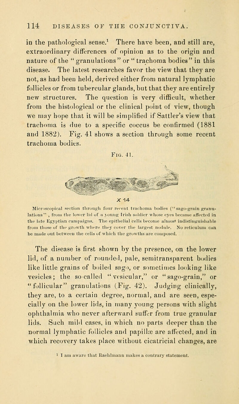 in the pathological sense.1 There have been, and still are, extraordinary differences of opinion as to the origin and nature of the  granulations  or  trachoma bodies  in this disease. The latest researches favor the view that they are not, as had been held, derived either from natural lymphatic follicles or from tubercular glands, but that they are entirely new structures. The question is very difficult, whether from the histological or the clinical point of view, though we may hope that it will be simplified if Sattler's view that trachoma is due to a specific coccus be confirmed (1881 and 1882). Fig. 41 shows a section through some recent trachoma bodies. Fig. 41. X 14 Microscopical section through four recent trachoma bodies (sago-grain granu- lations , from the lower lid of a .loung Irish soldier whose eyes became affected in the late Egyptian campaigns. The epithelial cells become almost indistinguishable from those of the growth where they cover the largest nodule. No reticulum can be made out between the cells of which the growths are composed. The disease is first shown by the presence, on the lower lid, of a number of rounded, pale, semitransparent bodies like little grains of boiled sago, or sometimes looking like vesicles; the so-called vesicular, or sago-grain, or follicular granulations (Fig. 42). Judging clinically, they are, to a certain degree, normal, and are seen, espe- cially on the lower lids, in many young persons with slight ophthalmia who never afterward suffer from true granular lids. Such mild cases, in which no parts deeper than the normal lymphatic follicles and papilhc are affected, and in which recovery takes place without cicatricial changes, are 1 I am aware that Kaehlmauu makes a contrary statement.