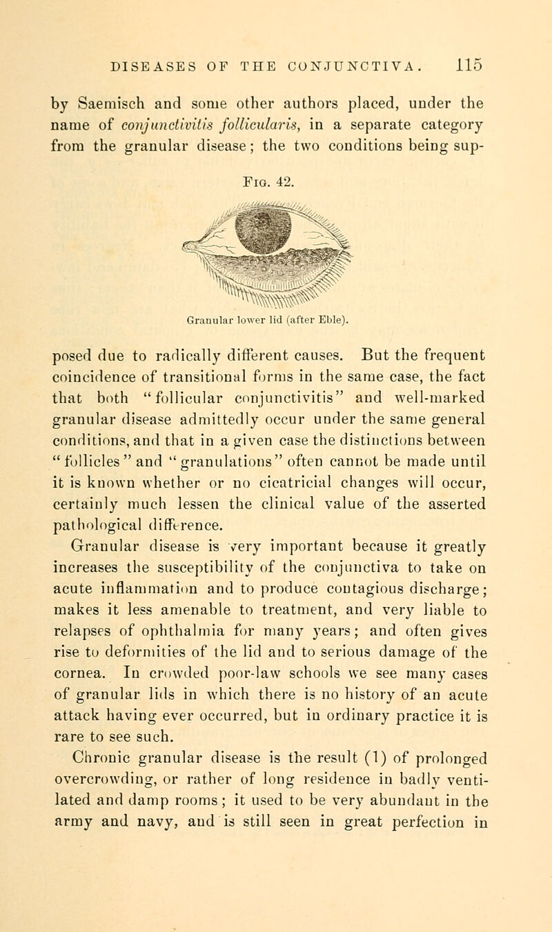 by Saemisch and some other authors placed, under the name of conjunctivitis follicularis, in a separate category from the granular disease; the two conditions being sup- Granular lower lid (after Eble). posed due to radically different causes. But the frequent coincidence of transitional forms in the same case, the fact that both follicular conjunctivitis and well-marked granular disease admittedly occur under the same general conditions, and that in a given case the distinctions between  follicles and granulations often cannot be made until it is known whether or no cicatricial changes will occur, certainly much lessen the clinical value of the asserted pathological difference. Granular disease is very important because it greatly increases the susceptibility of the conjunctiva to take on acute inflammation and to produce contagious discharge; makes it less amenable to treatment, and very liable to relapses of ophthalmia for many years; and often gives rise to deformities of the lid and to serious damage of the cornea. In crowded poor-law schools we see many cases of granular lids in which there is no history of an acute attack having ever occurred, but in ordinary practice it is rare to see such. Chronic granular disease is the result (1) of prolonged overcrowding, or rather of long residence in badly venti- lated and damp rooms ; it used to be very abundant in the army and navy, and is still seen in great perfection in