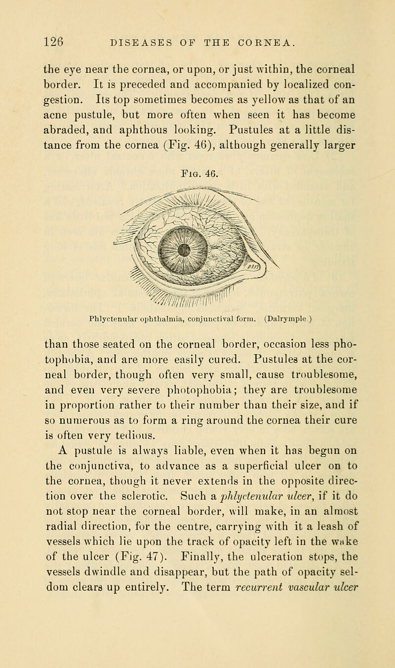 the eye near the cornea, or upon, or just within, the corneal border. It is preceded and accompanied by localized con- gestion. Its top sometimes becomes as yellow as that of an acne pustule, but more often when seen it has become abraded, and aphthous looking. Pustules at a little dis- tance from the cornea (Fig. 46), although generally larger Fig. 46. ' iji/iiiiii'i■' Phlyctenular ophthalmia, conjunctival form. (Dalrymple ) than those seated on the corneal border, occasion less pho- tophobia, and are more easily cured. Pustules at the cor- neal border, though often very small, cause troublesome, and even very severe photophobia; they are troublesome in proportion rather to their number than their size, and if so numerous as to form a ring around the cornea their cure is often very tedious. A pustule is always liable, even when it has begun on the conjunctiva, to advance as a superficial ulcer on to the cornea, though it never extends in the opposite direc- tion over the sclerotic. Such a, phlyctenular ulcer, if it do not stop near the corneal border, will make, in an almost radial direction, for the centre, carrying with it a leash of vessels which lie upon the track of opacity left in the wake of the ulcer (Fig. 47). Finally, the ulceration stops, the vessels dwindle and disappear, but the path of opacity sel- dom clears up entirely. The term recurrent vascular ulcer