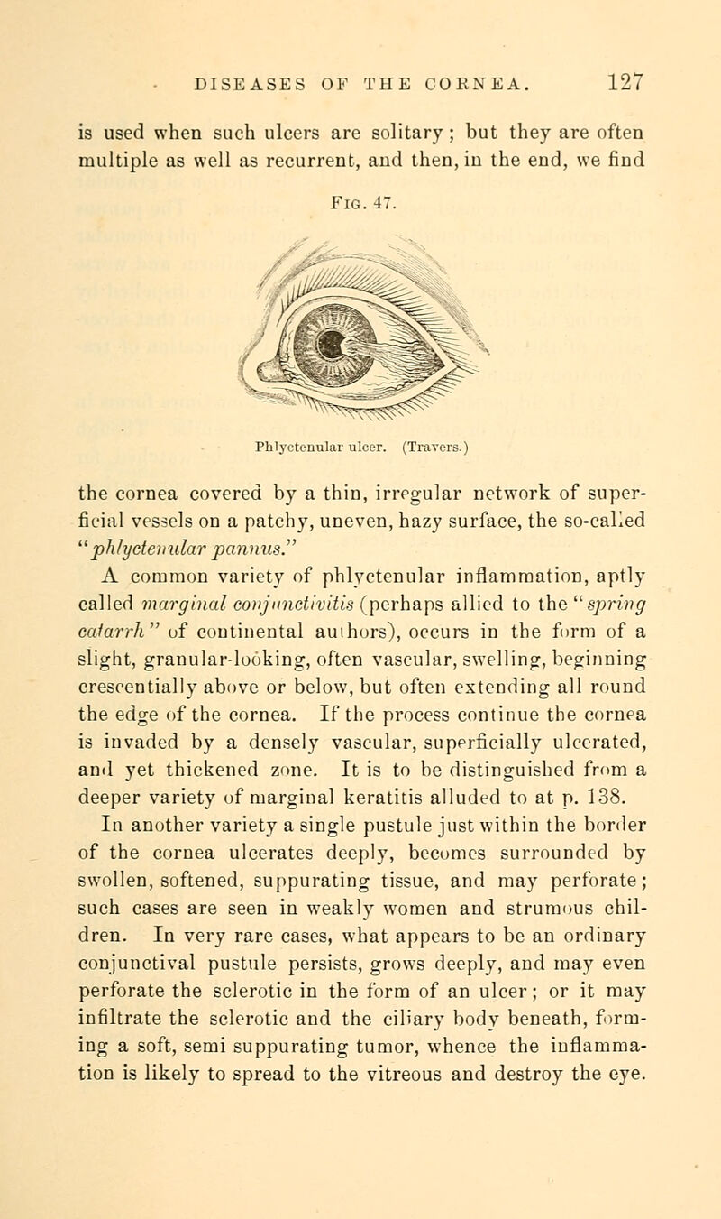 is used when such ulcers are solitary; but they are often multiple as well as recurrent, and then, in the end, we find Fig. 47. Phljxtenular ulcer. (Travers.) the cornea covered by a thin, irregular network of super- ficial vessels on a patchy, uneven, hazy surface, the so-called phlyctenular pannus. A common variety of phlyctenular inflammation, aptly called marginal conjunctivitis (perhaps allied to the spring catarrh of continental authors), occurs in the form of a slight, granular-looking, often vascular, swelling, beginning crescentially above or below, but often extending all round the edge of the cornea. If the process continue the cornea is invaded by a densely vascular, superficially ulcerated, and yet thickened zone. It is to be distinguished from a deeper variety of marginal keratitis alluded to at p. 138. In another variety a single pustule just within the border of the cornea ulcerates deeply, becomes surrounded by swollen, softened, suppurating tissue, and may perforate; such cases are seen in weakly women and strumous chil- dren. In very rare cases, what appears to be an ordinary conjunctival pustule persists, grows deeply, and may even perforate the sclerotic in the form of an ulcer; or it may infiltrate the sclerotic and the ciliary body beneath, form- ing a soft, semi suppurating tumor, whence the inflamma- tion is likely to spread to the vitreous and destroy the eye.