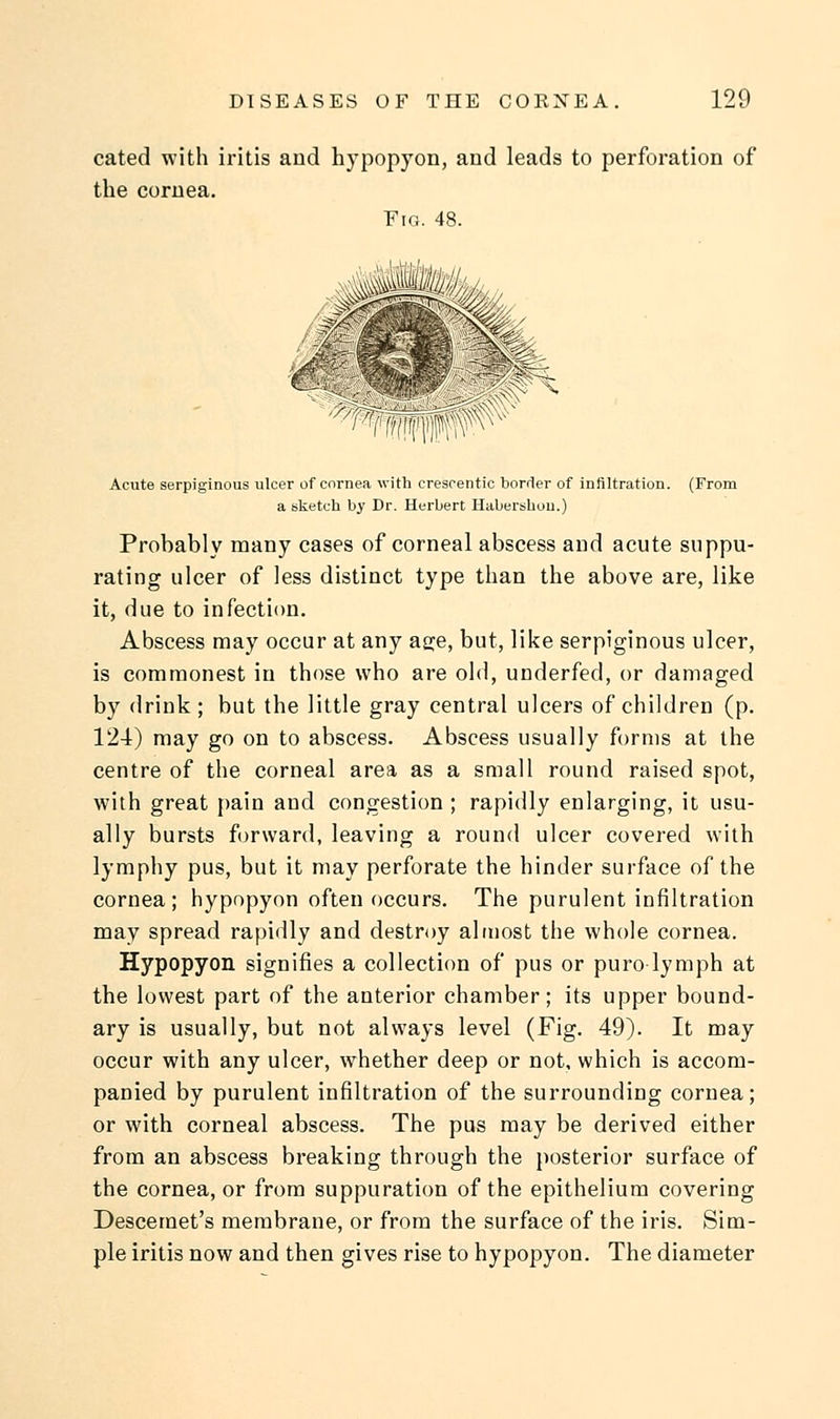 cated with iritis and h)rpopyon, and leads to perforation of the cornea. Fig. 48. Acute serpiginous ulcer of cornea with creseentic border of infiltration. (From a sketch by Dr. Herbert Habershou.) Probably many cases of corneal abscess and acute suppu- rating ulcer of less distinct type than the above are, like it, due to infection. Abscess may occur at any ao;e, but, like serpiginous ulcer, is commonest in those who are old, underfed, or damaged by drink; but the little gray central ulcers of children (p. 124) may go on to abscess. Abscess usually forms at the centre of the corneal area as a small round raised spot, with great pain and congestion ; rapidly enlarging, it usu- ally bursts forward, leaving a round ulcer covered with lymphy pus, but it may perforate the hinder surface of the cornea; hypopyon often occurs. The purulent infiltration may spread rapidly and destroy almost the whole cornea. Hypopyon signifies a collection of pus or puro lymph at the lowest part of the anterior chamber; its upper bound- ary is usually, but not always level (Fig. 49). It may occur with any ulcer, whether deep or not, which is accom- panied by purulent infiltration of the surrounding cornea; or with corneal abscess. The pus may be derived either from an abscess breaking through the posterior surface of the cornea, or from suppuration of the epithelium covering Descemet's membrane, or from the surface of the iris. Sim- ple iritis now and then gives rise to hypopyon. The diameter