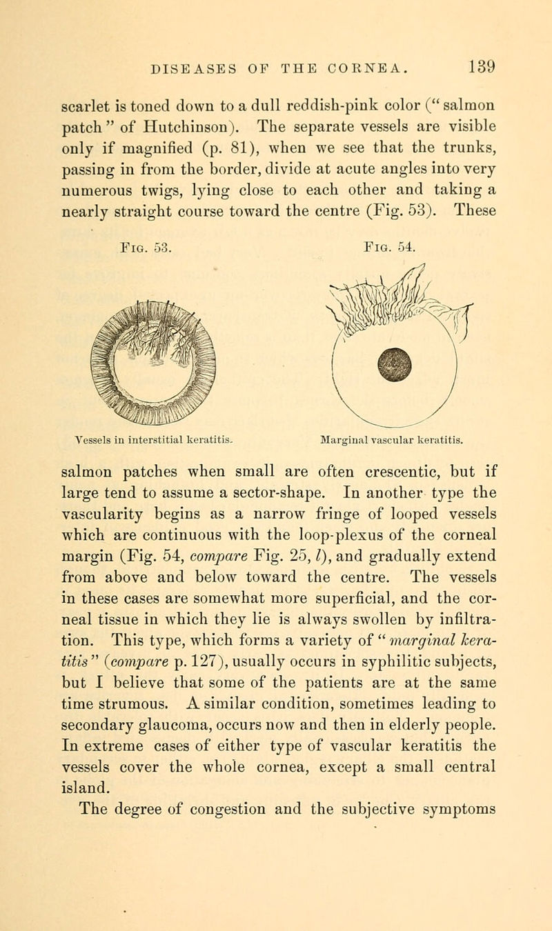 scarlet is toned down to a dull reddish-pink color ( salmon patch  of Hutchinson). The separate vessels are visible only if magnified (p. 81), when we see that the trunks, passing in from the border, divide at acute angles into very numerous twigs, lying close to each other and takiDg a nearly straight course toward the centre (Fig. 53). These Fig. 53. Fig. 54. Vessels in interstitial keratitis- Marjriual vascular keratitis. salmon patches when small are often crescentic, but if large tend to assume a sector-shape. In another type the vascularity begins as a narrow fringe of looped vessels which are continuous with the loop-plexus of the corneal margin (Fig. 54, compare Fig. 25,1), and gradually extend from above and below toward the centre. The vessels in these cases are somewhat more superficial, and the cor- neal tissue in which they lie is always swollen by infiltra- tion. This type, which forms a variety of  marginal kera- titis {compare p. 127), usually occurs in syphilitic subjects, but I believe that some of the patients are at the same time strumous. A similar condition, sometimes leading to secondary glaucoma, occurs now and then in elderly people. In extreme cases of either type of vascular keratitis the vessels cover the whole cornea, except a small central island. The degree of congestion and the subjective symptoms