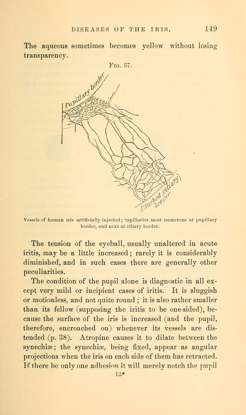 The aqueous sometimes becomes yellow without losing transparency. Fig. 57. Vessels of human iris artificially injected; capillaries most numerous at pupillary border, and next at ciliary border. The tension of the eyeball, usually unaltered in acute iritis, may be a little increased; rarely it is considerably diminished, and in such cases there are generally other peculiarities. The condition of the pupil alone is diagnostic in all ex- cept very mild or incipient cases of iritis. It is sluggish or motionless, and not quite round ; it is also rather smaller than its fellow (supposing the iritis to be one-sided), be- cause the surface of the iris is increased (and the pupil, therefore, encroached on) whenever its vessels are dis- tended (p. 38). Atropine causes it to dilate between the synechia?; the synechia?, being fixed, appear as angular projections when the iris on each side of them has retracted. If there be only one adhesion it will merely notch the pupil 13*