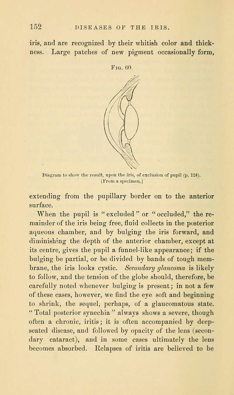 iris, and are recognized by their whitish color and thick- ness. Large patches of new pigment occasionally form, Fig. 60. Diagram to show the result, upon the iris, of exclusion of pupil (p. 124). (From a specimen.) extending from the pupillary border on to the anterior surface. When the pupil is  excluded  or  occluded, the re- mainder of the iris being free, fluid collects in the posterior aqueous chamber, and by bulging the iris forward, and diminishing the depth of the anterior chamber, except at its centre, gives the pupil a funnel-like appearance; if the bulging be partial, or be divided by bands of tough mem- brane, the iris looks cystic. Secondary glaucoma is likely to follow, and the tension of the globe should, therefore, be carefully noted whenever bulging is present; in not a few of these cases, however, we find the eye soft and beginning to shrink, the sequel, perhaps, of a glaucomatous state.  Total posterior synechia  always shows a severe, though often a chronic, iritis; it is often accompanied by deep- seated disease, and followed by opacity of the lens (secon- dary cataract), and in some cases ultimately the lens becomes absorbed. Relapses of iritis are believed to be