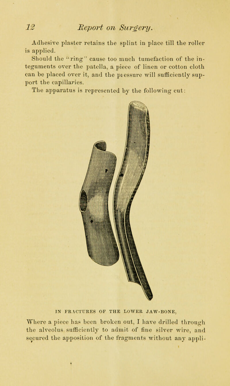 Adhesive plaster retains the splint in place till the roller is applied. Should the -'ring cause too much tumefaction of the in- teguments over the patella, a piece of linen or cotton cloth can be placed over it, and the pleasure will sufficiently sup- port the capillaries. The apparatus is represented by the following cut: IN FRACTURES OF THE LOWER JAW-BONE, Where a piece has been broken out, I have drilled through the alveolus sufficiently to admit of fine silver wire, and secured the apposition of the fragments without any appli-