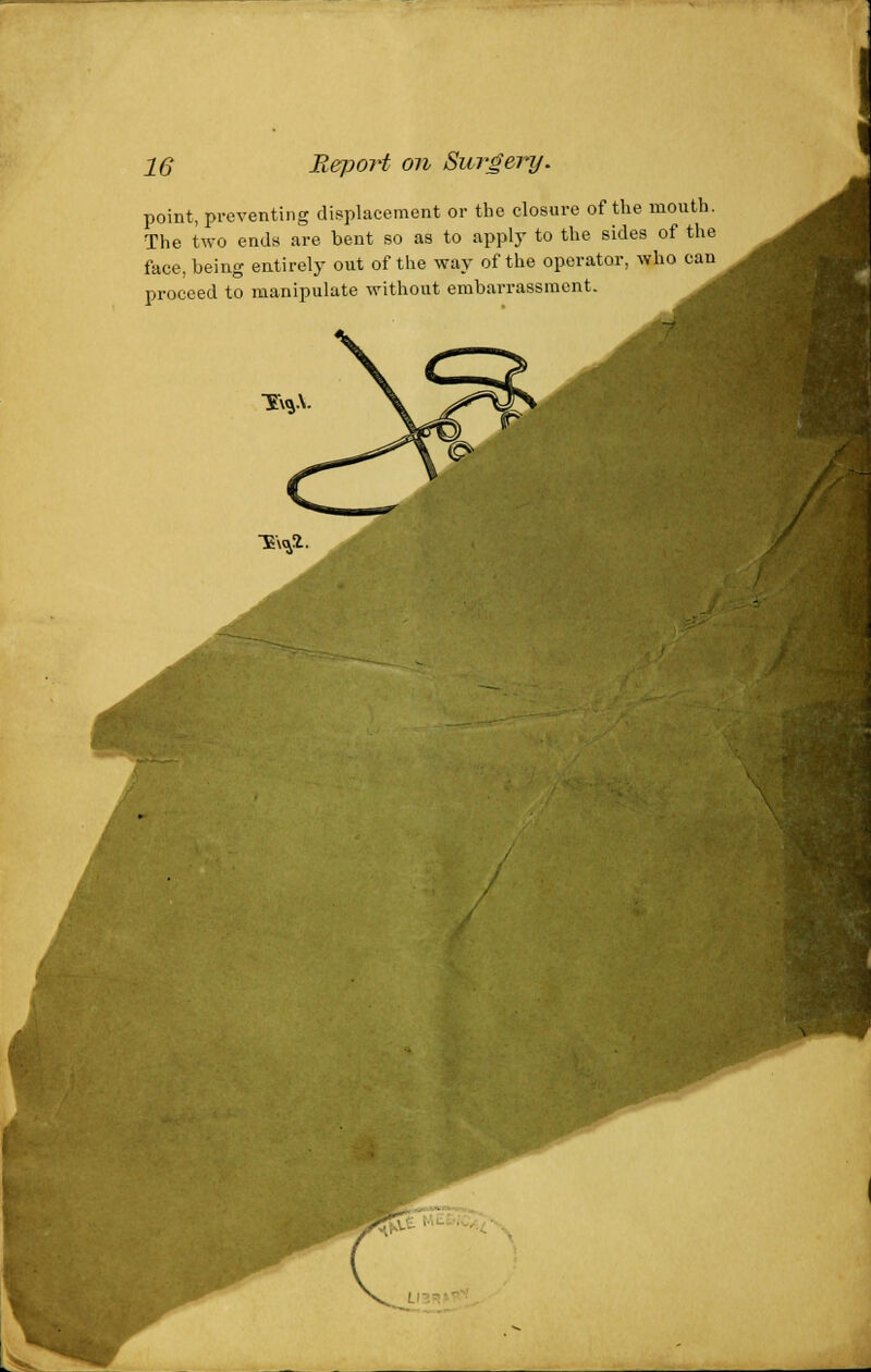 point, preventing displacement or the closure of the mouth. The two ends are bent so as to apply to the sides of the face, being entirely out of the way of the operator, who can^ proceed to manipulate without embarrassment. T\*\ -E\*2.