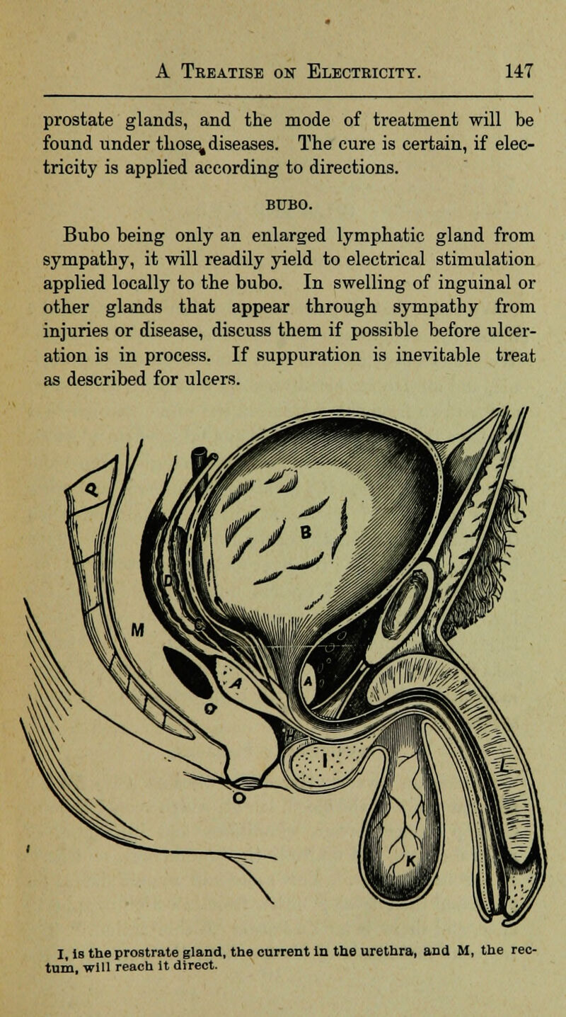 prostate glands, and the mode of treatment will be found under those^ diseases. The cure is certain, if elec- tricity is applied according to directions. BUBO. Bubo being only an enlarged lymphatic gland from sympathy, it will readily yield to electrical stimulation applied locally to the bubo. In swelling of inguinal or other glands that appear through sympathy from injuries or disease, discuss them if possible before ulcer- ation is in process. If suppuration is inevitable treat as described for ulcers. I, is the prostrate gland, the current in the urethra, ana M, the rec- tum, will reach it direct.