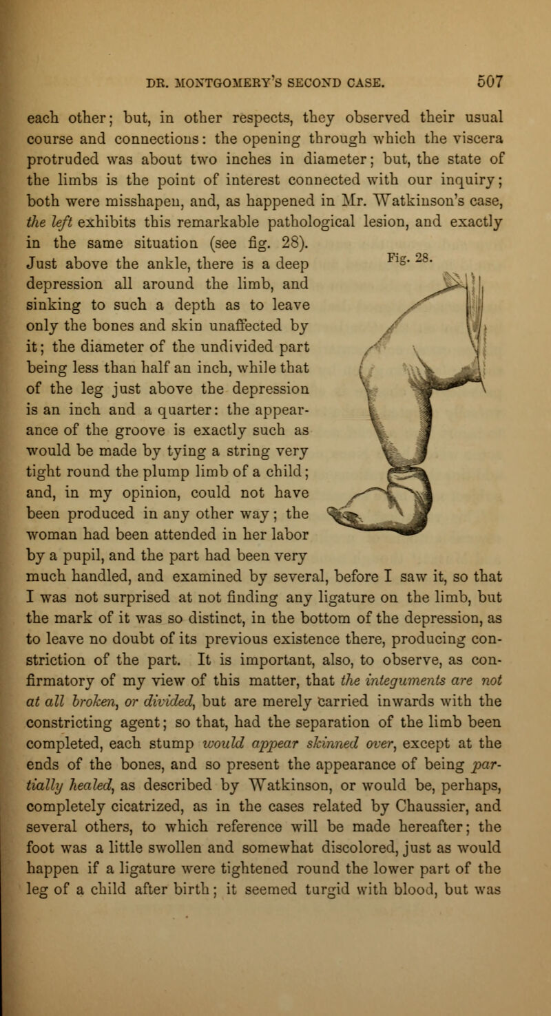 Fig. 28. each other; but, in other respects, they observed their usual course and connections: the opening through which the viscera protruded was about two inches in diameter; but, the state of the limbs is the point of interest connected with our inquiry; both were misshapen, and, as happened in Mr. TTatkinson's case, the left exhibits this remarkable pathological lesion, and exactly in the same situation (see fig. 28). Just above the ankle, there is a deep depression all around the limb, and sinking to such a depth as to leave only the bones and skin unaffected by it; the diameter of the undivided part being less than half an inch, while that of the leg just above the depression is an inch and a quarter: the appear- ance of the groove is exactly such as would be made by tying a string very tight round the plump limb of a child; and, in my opinion, could not have been produced in any other way; the woman had been attended in her labor by a pupil, and the part had been very much handled, and examined by several, before I saw it, so that I was not surprised at not finding any ligature on the limb, but the mark of it was so distinct, in the bottom of the depression, as to leave no doubt of its previous existence there, producing con- striction of the part. It is important, also, to observe, as con- firmatory of my view of this matter, that the integuments are not at all broken, or divided, but are merely carried inwards with the constricting agent; so that, had the separation of the limb been completed, each stump icould appear shinned over, except at the ends of the bones, and so present the appearance of being par- tially healed, as described by Watkinson, or would be, perhaps, completely cicatrized, as in the cases related by Chaussier, and several others, to which reference will be made hereafter; the foot was a little swollen and somewhat discolored, just as would happen if a ligature were tightened round the lower part of the leg of a child after birth; it seemed turgid with blood, but was