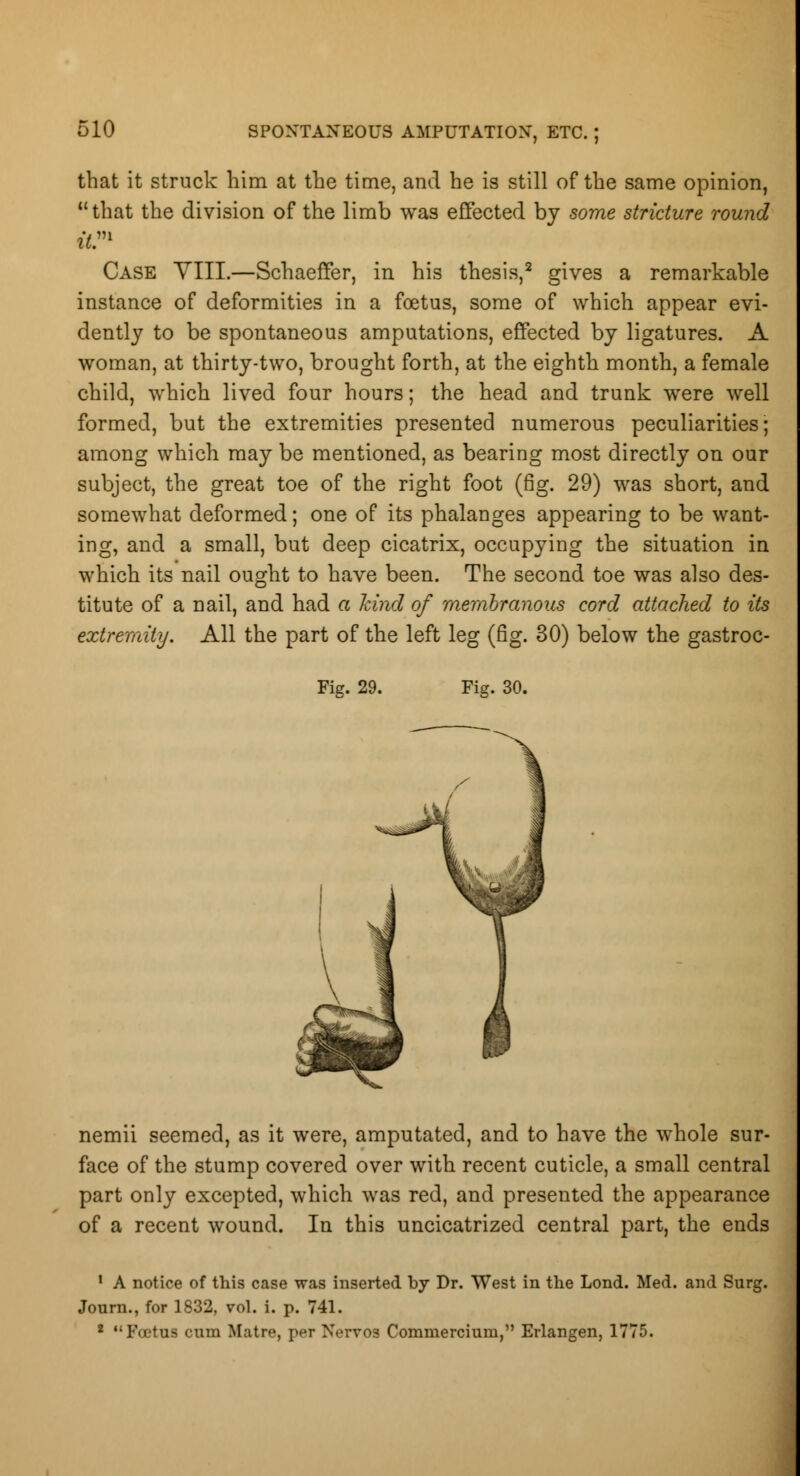 that it struck him at the time, and he is still of the same opinion, that the division of the limb was effected by some stricture round it.m Case YIII.—Schaeffer, in his thesis,2 gives a remarkable instance of deformities in a foetus, some of which appear evi- dently to be spontaneous amputations, effected by ligatures. A woman, at thirty-two, brought forth, at the eighth month, a female child, which lived four hours; the head and trunk were well formed, but the extremities presented numerous peculiarities; among which may be mentioned, as bearing most directly on our subject, the great toe of the right foot (fig. 29) was short, and somewhat deformed; one of its phalanges appearing to be want- ing, and a small, but deep cicatrix, occupying the situation in which its nail ought to have been. The second toe was also des- titute of a nail, and had a hind of membranous cord attached to its extremity. All the part of the left leg (fig. 30) below the gastroc- Fig. 29. Fig. 30. nemii seemed, as it were, amputated, and to have the whole sur- face of the stump covered over with recent cuticle, a small central part only excepted, which was red, and presented the appearance of a recent wound. In this uncicatrized central part, the ends 1 A notice of this case was inserted by Dr. West in the Lond. Med. and Surg. Journ., for 1832, vol. i. p. 741. 2 Foetw omn Matre, per Nervos Commercium, Erlangen, 1775.