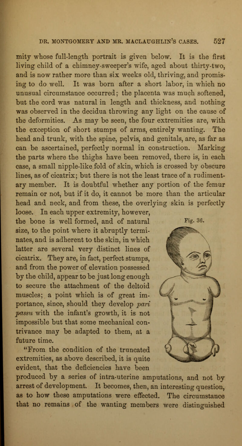 mity whose full-length portrait is given below. It is the first living child of a chimney-sweeper's wife, aged about thirty-two, and is now rather more than six weeks old, thriving, and promis- ing to do well. It was born after a short labor, in which no unusual circumstance occurred; the placenta was much softened, but the cord was natural in length and thickness, and nothing was observed in the decidua throwing any light on the cause of the deformities. As may be seen, the four extremities are, with the exception of short stumps of arms, entirely wanting. The head and trunk, with the spine, pelvis, and genitals, are, as far as can be ascertained, perfectly normal in construction. Marking the parts where the thighs have been removed, there is, in each case, a small nipple-like fold of skin, which is crossed by obscure lines, as of cicatrix; but there is not the least trace of a rudiment- ary member. It is doubtful whether any portion of the femur remain or not, but if it do, it cannot be more than the articular head and neck, and from these, the overlying skin is perfectly loose. In each upper extremity, however, the bone is well formed, and of natural size, to the point where it abruptly termi- nates, and is adherent to the skin, in which latter are several very distinct lines of cicatrix. They are, in fact, perfect stumps, and from the power of elevation possessed by the child, appear to be just long enough to secure the attachment of the deltoid muscles; a point which is of great im- portance, since, should they develop pari passu with the infant's growth, it is not impossible but that some mechanical con- trivance may be adapted to them, at a future time. From the condition of the truncated extremities, as above described, it is quite evident, that the deficiencies have been produced by a series of intra-uterine amputations, and not by arrest of development. It becomes, then, an interesting question, as to how these amputations were effected. The circumstance that no remains of the wanting members were distinguished