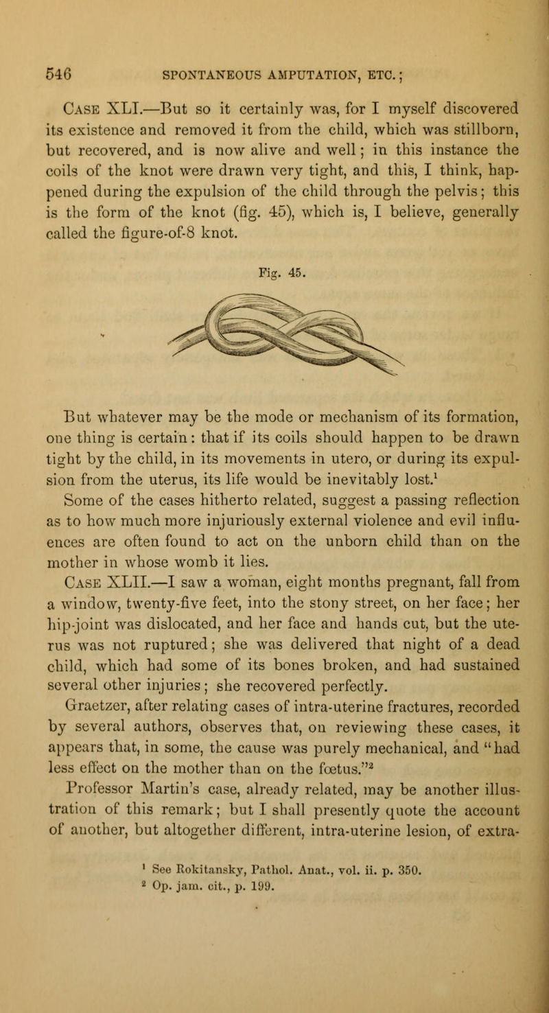 Case XLI.—But so it certainly was, for I myself discovered its existence and removed it from the child, which was stillborn, but recovered, and is now alive and well; in this instance the coils of the knot were drawn very tight, and this, I think, hap- pened during the expulsion of the child through the pelvis; this is the form of the knot (fig. 45), which is, I believe, generally called the figure-of-8 knot. Fiff. 45. But whatever may be the mode or mechanism of its formation, one thing is certain: that if its coils should happen to be drawn tight by the child, in its movements in utero, or during its expul- sion from the uterus, its life would be inevitably lost.1 Some of the cases hitherto related, suggest a passing reflection as to how much more injuriously external violence and evil influ- ences are often found to act on the unborn child than on the mother in whose womb it lies. Case XLII.—I saw a woman, eight months pregnant, fall from a window, twenty-five feet, into the stony street, on her face; her hip-joint was dislocated, and her face and hands cut, but the ute- rus was not ruptured; she was delivered that night of a dead child, which had some of its bones broken, and had sustained several other injuries; she recovered perfectly. Graetzer, after relating cases of intra-uterine fractures, recorded by several authors, observes that, on reviewing these cases, it appears that, in some, the cause was purely mechanical, and had less effect on the mother than on the foetus.2 Professor Martin's case, already related, may be another illus- tration of this remark; but I shall presently quote the account of another, but altogether different, intra-uterine lesion, of extra- 1 See Rokitansky, Pathol. Anat., vol. ii. p. 350. 2 Op. jam. oit., p. 109.