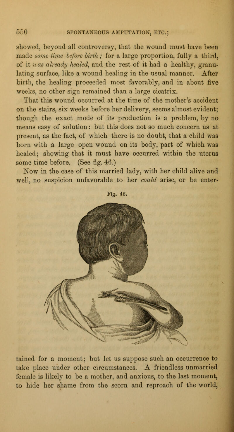 5C0 showed, beyond all controversy, that the wound must have been made some time before birth; for a large proportion, fully a third, of it uas already healed, and the rest of it had a healthy, granu- lating surface, like a wound healing in the usual manner. After birth, the healing proceeded most favorably, and in about five weeks, no other sign remained than a large cicatrix. That this wound occurred at the time of the mother's accident on the stairs, six weeks before her delivery, seems almost evident; though the exact mode of its production is a problem, by no means easy of solution: but this does not so much concern us at present, as the fact, of which there is no doubt, that a child was born with a large open wound on its body, part of which was healed; showing that it must have occurred within the uterus some time before. (See fig. 46.) Now in the case of this married lady, with her child alive and well, no suspicion unfavorable to her could arise, or be enter- Fig. 46. tained for a moment; but let us suppose such an occurrence to take place under other circumstances. A friendless unmarried female is likely to be a mother, and anxious, to the last moment, to hide her shame from the scorn and reproach of the world,