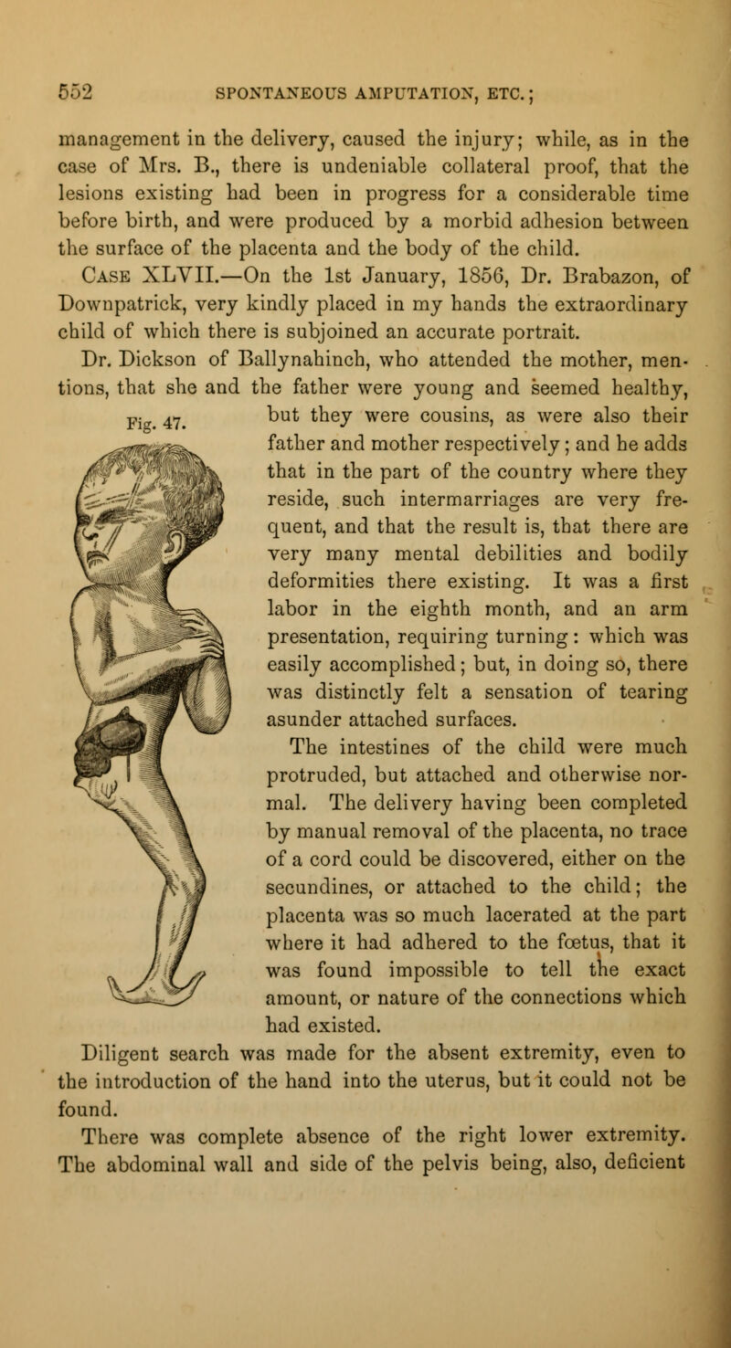 Fig. 47. management in the delivery, caused the injury; while, as in the case of Mrs. B., there is undeniable collateral proof, that the lesions existing had been in progress for a considerable time before birth, and were produced by a morbid adhesion between the surface of the placenta and the body of the child. Case XLYIL—On the 1st January, 1856, Dr. Brabazon, of Downpatrick, very kindly placed in my hands the extraordinary child of which there is subjoined an accurate portrait. Dr. Dickson of Ballynahinch, who attended the mother, men- tions, that she and the father were young and seemed healthy, but they were cousins, as were also their father and mother respectively; and he adds that in the part of the country where they reside, such intermarriages are very fre- quent, and that the result is, that there are very many mental debilities and bodily deformities there existing. It was a first labor in the eighth month, and an arm presentation, requiring turning: which was easily accomplished; but, in doing so, there was distinctly felt a sensation of tearing asunder attached surfaces. The intestines of the child were much protruded, but attached and otherwise nor- mal. The delivery having been completed by manual removal of the placenta, no trace of a cord could be discovered, either on the secundines, or attached to the child; the placenta was so much lacerated at the part where it had adhered to the foetus, that it was found impossible to tell the exact amount, or nature of the connections which had existed. Diligent search was made for the absent extremity, even to the introduction of the hand into the uterus, but it could not be found. There was complete absence of the right lower extremity. The abdominal wall and side of the pelvis being, also, deficient