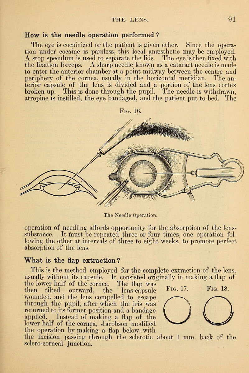 How is the needle operation performed ? The eye is cocainized or the patient is given ether. Since the opera- tion under cocaine is painless, this local anaesthetic may be employed. A stop speculum is used to separate the lids. The eye is then fixed with the fixation forceps. A sharp needle known as a cataract needle is made to enter the anterior chamber at a point midway between the centre and periphery of the cornea, usually in the horizontal meridian. The an- terior capsule of the lens is divided and a portion of the lens cortex broken up. This is done through the pupil. The needle is withdrawn, atropine is instilled, the eye bandaged, and the patient put to bed. The Fig. 16. The Needle Operation. operation of needling affords opportunity for the absorption of the lens- substance. It must be repeated three or four times, one operation fol- lowing the other at intervals of three to eight weeks, to promote perfect absorption of the lens. What is the flap extraction? This is the method employed for the complete extraction of the lens, usually without its capsule. It consisted orjginally in making a flap of the lower half of the cornea, The flap was then tilted outward, the lens-capsule wounded, and the lens compelled to escape through the pupil, after which the iris was returned to its former position and a bandage applied. Instead of making a flap of the lower half of the cornea, Jacobson modified the operation by making a flap below, with the incision passing through the sclerotic about 1 mm. back of the sclero-corneal junction. Fig. 17. Fig. 18. oo