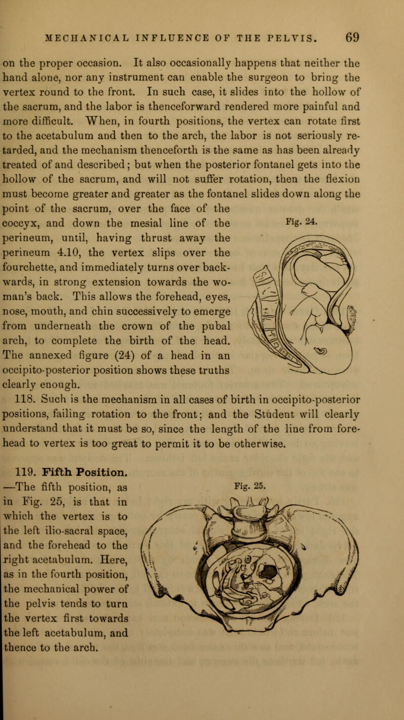 Fig. 24. on the proper occasion. It also occasionally happens that neither the hand alone, nor any instrument can enable the surgeon to bring the vertex round to the front. In such case, it slides into the hollow of the sacrum, and the labor is thenceforward rendered more painful and more difficult. When, in fourth positions, the vertex can rotate first to the acetabulum and then to the arch, the labor is not seriously re- tarded, and the mechanism thenceforth is the same as has been already treated of and described ; but when the posterior fontanel gets into the hollow of the sacrum, and will not suffer rotation, then the flexion must become greater and greater as the fontanel slides down along the point of the sacrum, over the face of the coccyx, and down the mesial line of the perineum, until, having thrust away the perineum 4.10, the vertex slips over the fourchette, and immediately turns over back- wards, in strong extension towards the wo- man's back. This allows the forehead, eyes, nose, mouth, and chin successively to emerge from underneath the crown of the pubal arch, to complete the birth of the head. The annexed figure (24) of a head in an occipito-posterior position shows these truths clearly enough. 118. Such is the mechanism in all cases of birth in occipito-posterior positions, failing rotation to the front; and the Student will clearly understand that it must be so, since the length of the line from fore- head to vertex is too great to permit it to be otherwise. 119. Fifth Position. —The fifth position, as in Fig. 25, is that in which the vertex is to the left ilio-sacral space, and the forehead to the right acetabulum. Here, as in the fourth position, the mechanical power of the pelvis tends to turn the vertex first towards the left acetabulum, and thence to the arch. Fig. 25.