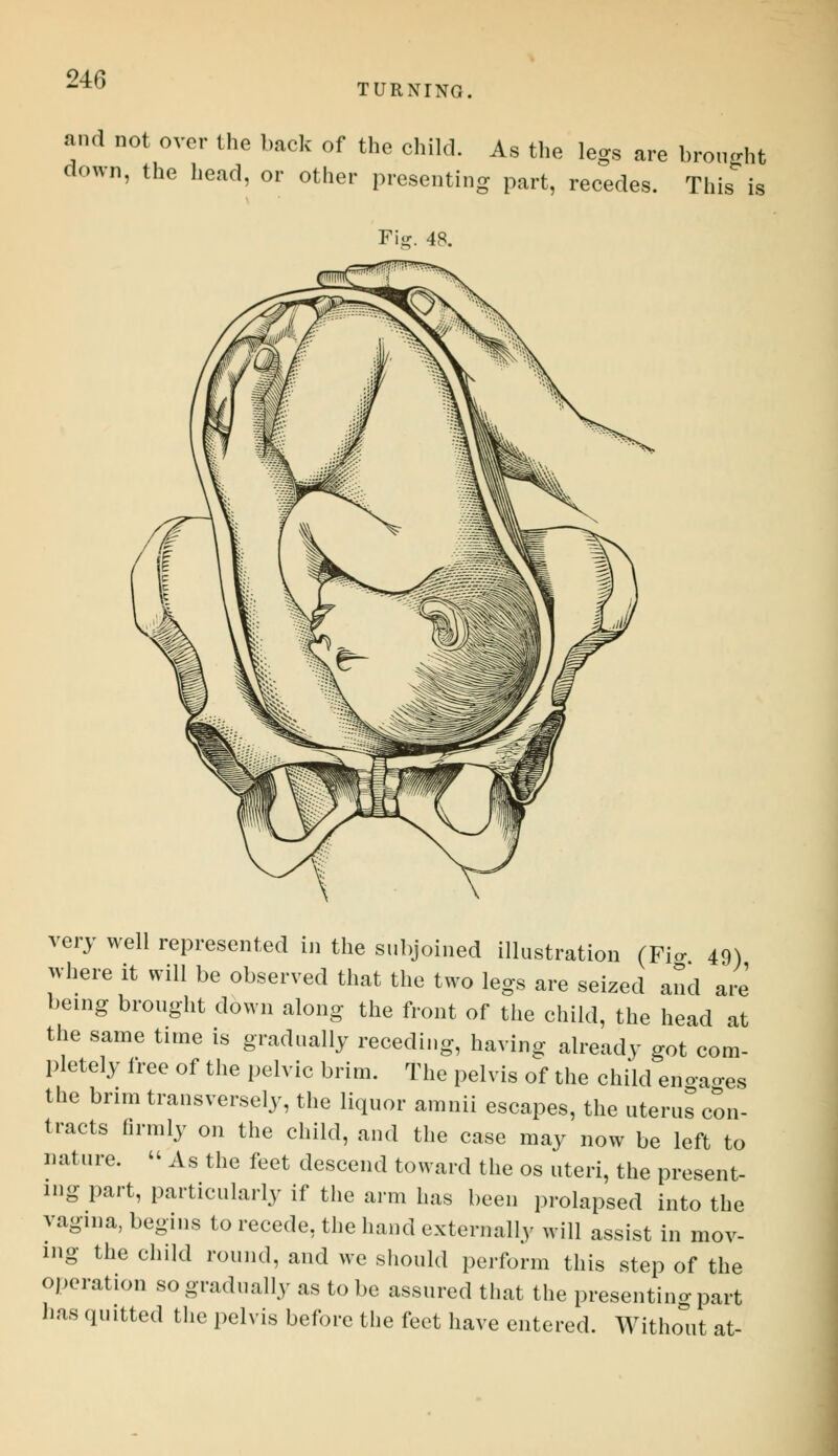 TURNING. and not over the back of the child. As the le^s are b the head, or other presenting part, recedes. ro nght This is Fig. 48. very well represented in the subjoined illustration (Fig 49) where it will be observed that the two legs are seized and are being brought down along the front of the child, the head at the same time is gradually receding, having already got com- pletely free of the pelvic brim. The pelvis of the child engages the brim transversely, the liquor amnii escapes, the uterus con- tracts firmly on the child, and the case may now be left to nature.  As the feet descend toward the os uteri, the present- ing part, particularly if the arm has been prolapsed into the vagina, begins to recede, the hand externally will assist in mov- ing the child round, and we should perform this step of the operation so gradually as to be assured that the presenting part has .putted the pelvis before the feet have entered. Without at-