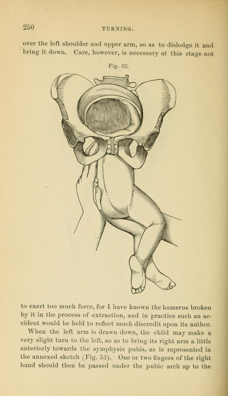 over the left shoulder and upper arm, so as to dislodge it and bring it down. Care, however, is necessary at this stage not Fig. 52. to exert too much force, for I have known the humerus broken by it in the process of extraction, and in practice such an ac- cident would be held to reflect much discredit upon its author. When the left arm is drawn down, the child may make a very slight turn to the left, so as to bring its right arm a little anteriorly towards the symphysis pubis, as is represented in the annexed sketch (Fig. 53). One or two fingers of the right hand should then be passed under the pubic arch up to the