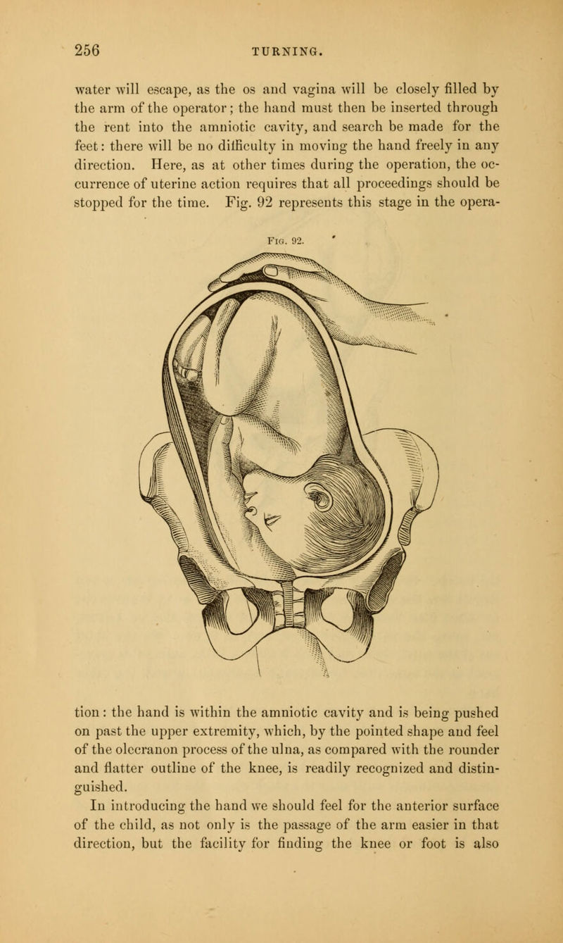 water will escape, as the os and vagina will be closely filled by the arm of the operator; the hand must then be inserted through the rent into the amniotic cavity, and search be made for the feet: there will be no dilficulty in moving the hand freely in any direction. Here, as at other times during the operation, the oc- currence of uterine action requires that all proceedings should be stopped for the time. Fig. 92 represents this stage in the opera- Fig. 92. tion: the hand is within the amniotic cavity and is being pushed on past the upper extremity, which, by the pointed shape and feel of the olecranon process of the ulna, as compared with the rounder and flatter outline of the knee, is readily recognized and distin- guished. In introducing the hand we should feel for the anterior surface of the child, as not only is the passage of the arm easier in that direction, but the facility for finding the knee or foot is also