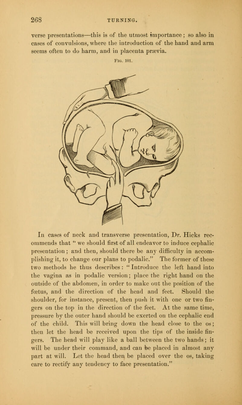 verse presentations—this is of the utmost importance ; so also in cases of convulsions, where the introduction of the hand and arm seems often to do harm, and in placenta previa. Fig. 101. In cases of neck and transverse presentation, Dr. Hicks rec- ommends that  we should first of all endeavor to induce cephalic presentation ; and theu, should there be any difficulty in accom- plishing it, to change our plans to podalic. The former of these two methods he thus describes :  Introduce the left hand into the vagina as in podalic version; place the right hand on the outside of the abdomen, in order to make out the position of the foetus, and the direction of the head and feet. Should the shoulder, for instance, present, then push it with one or two fin- gers on the top in the direction of the feet. At the same time, pressure by the outer hand should be exerted on the cephalic end of the child. This will bring down the head close to the os; then let the head be received upon the tips of the inside fin- gers. The head will play like a ball between the two hands; it will be under their command, and can be placed in almost any part at will. Let the head then be placed over the os, taking care to rectify any tendency to face presentation.