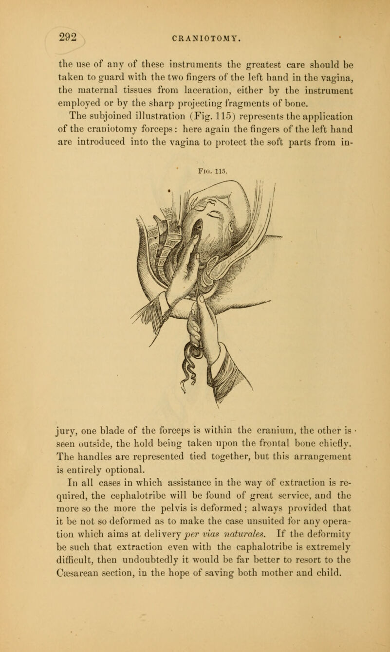 the use of any of these instruments the greatest care should be taken to guard with the two fingers of the left hand in the vagina, the maternal tissues from laceration, either by the instrument employed or by the sharp projecting fragments of bone. The subjoined illustration (Fig. 115) represents the application of the craniotomy forceps : here again the fingers of the left hand are introduced into the vagina to protect the soft parts from in- Fig. 115 jury, one blade of the forceps is within the cranium, the other is seen outside, the hold being taken upon the frontal bone chiefly. The handles are represented tied together, but this arrangement is entirely optional. In all cases in which assistance in the way of extraction is re- quired, the cephalotribe will be found of great service, and the more so the more the pelvis is deformed ; always provided that it be not so deformed as to make the case unsuited for any opera- tion which aims at delivery per vias naturales. If the deformity be such that extraction even with the caphalotribe is extremely difficult, then undoubtedly it would be far better to resort to the Cesarean section, iu the hope of saving both mother and child.