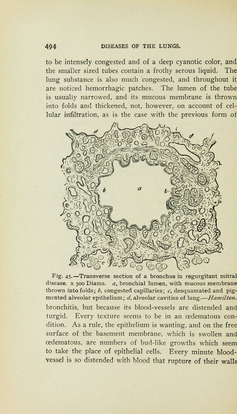 to be intensely congested and of a deep cyanotic color, and the smaller sized tubes contain a frothy serous liquid. The lung substance is also much congested, and throughout it are noticed hemorrhagic patches. The lumen of the tube is usually narrowed, and its mucous membrane is thrown into folds and thickened, not, however, on account of cel- lular infiltration, as is the case with the previous form of Fig. 45.—Transverse section of a bronchus in regurgitant mitral disease, x 300 Diams. a, bronchial lumen, with mucous membrane thrown into folds; 6, congested capillaries; c, desquamated and pig- mented alveolar epithelium; d, alveolar cavities of lung.—Hamilton. bronchitis, but because its blood-vessels are distended and turgid. Every texture seems to be in an oedematous con- dition. As a rule, the epithelium is wanting, and on the free surface of the basement membrane, which is swollen and cedematous, are numbers of bud-like growths which seem to take the place of epithelial cells. Every minute blood- vessel is so distended with blood that rupture of their walls